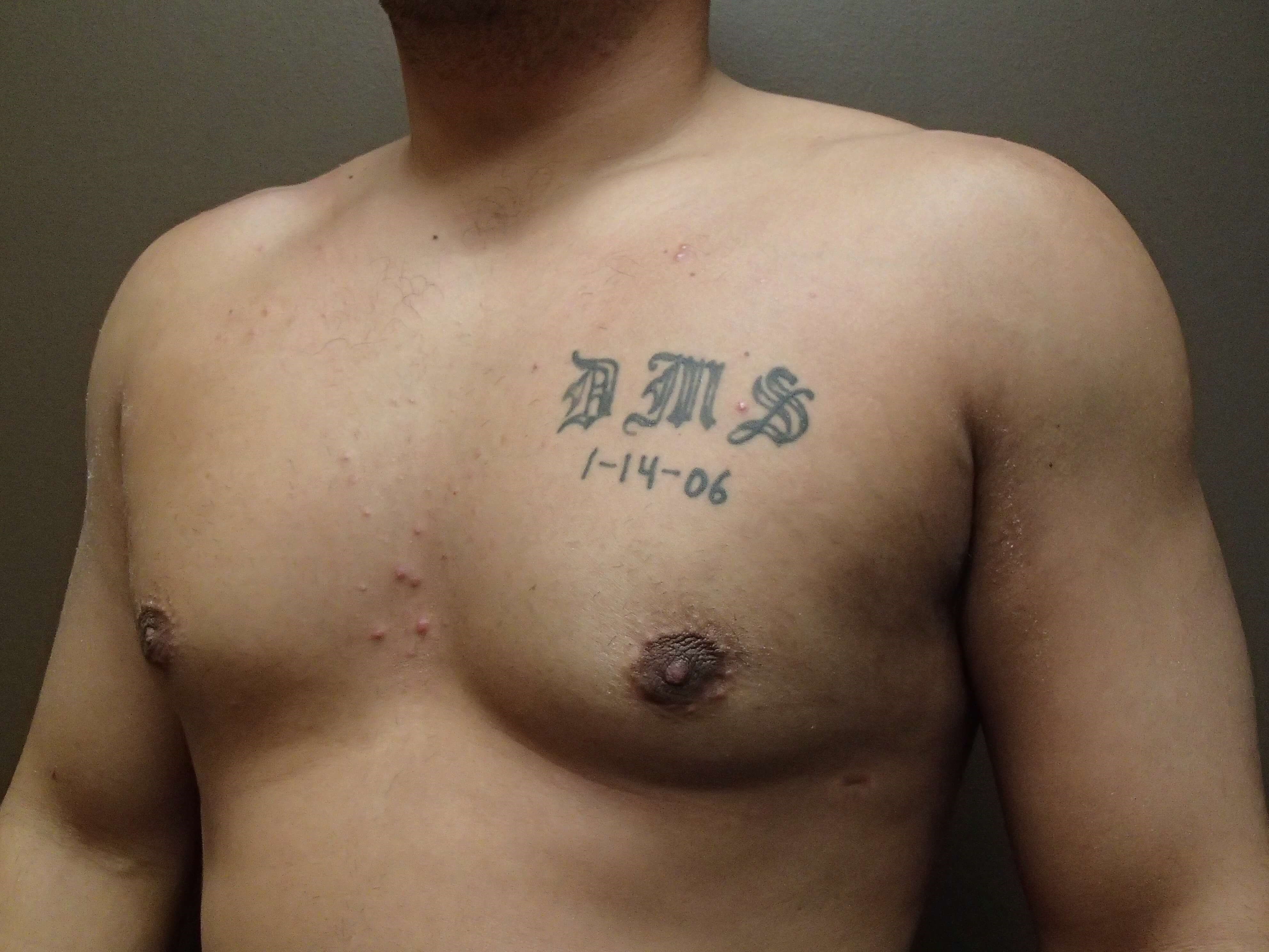 Gynecomastia (male breast redu After