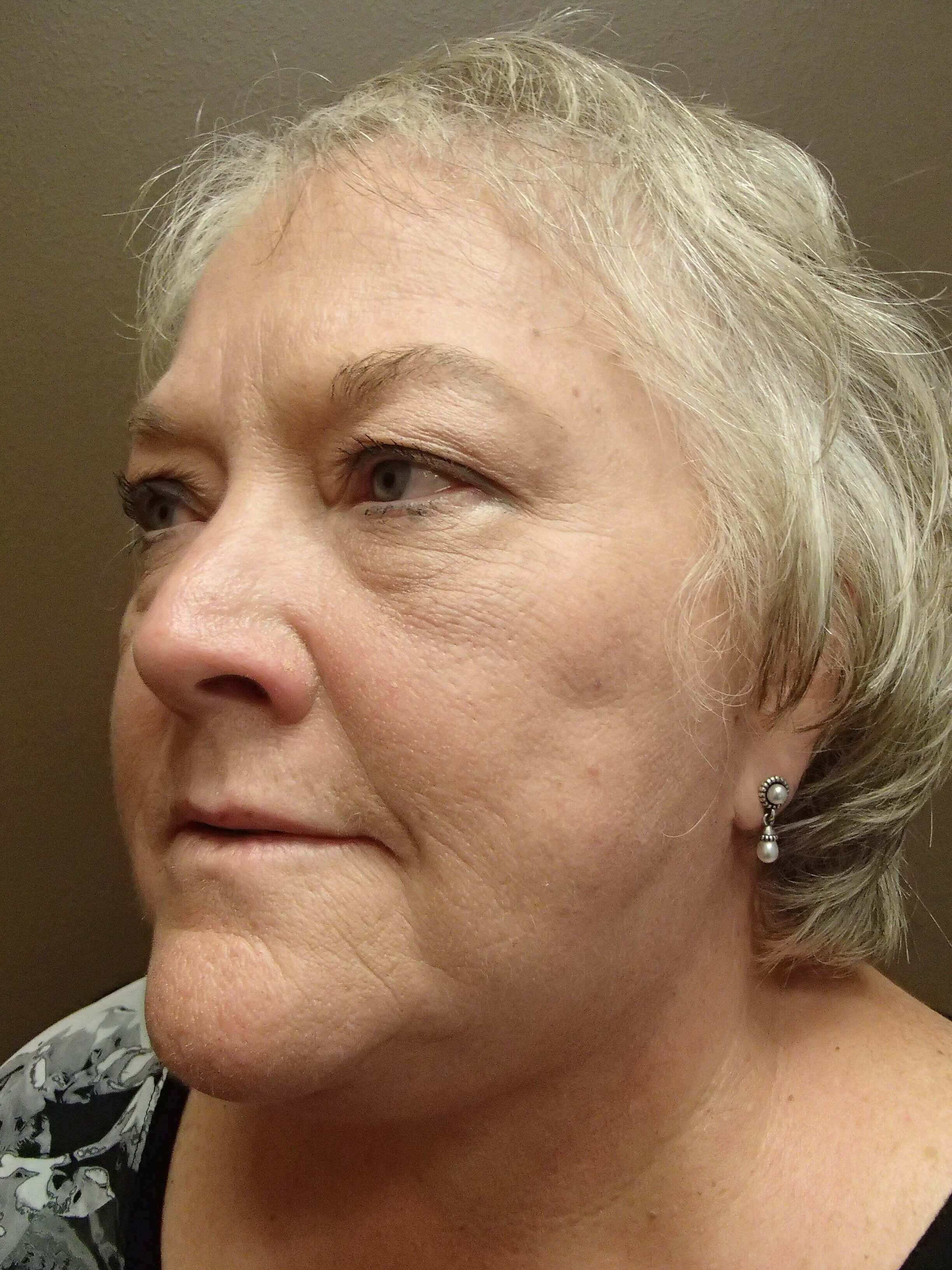 Facelift and Necklift After