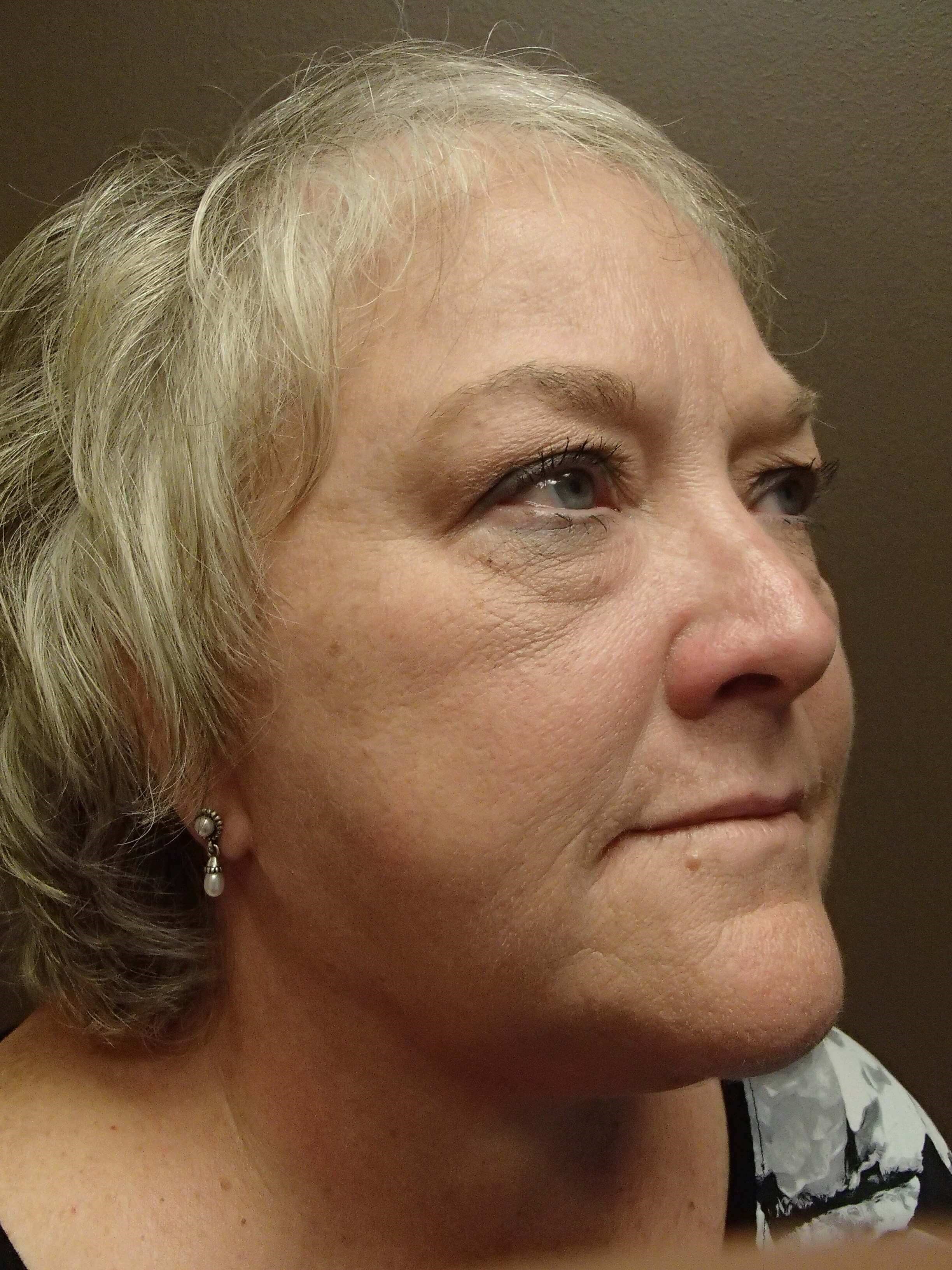 Facelift and Necklift After