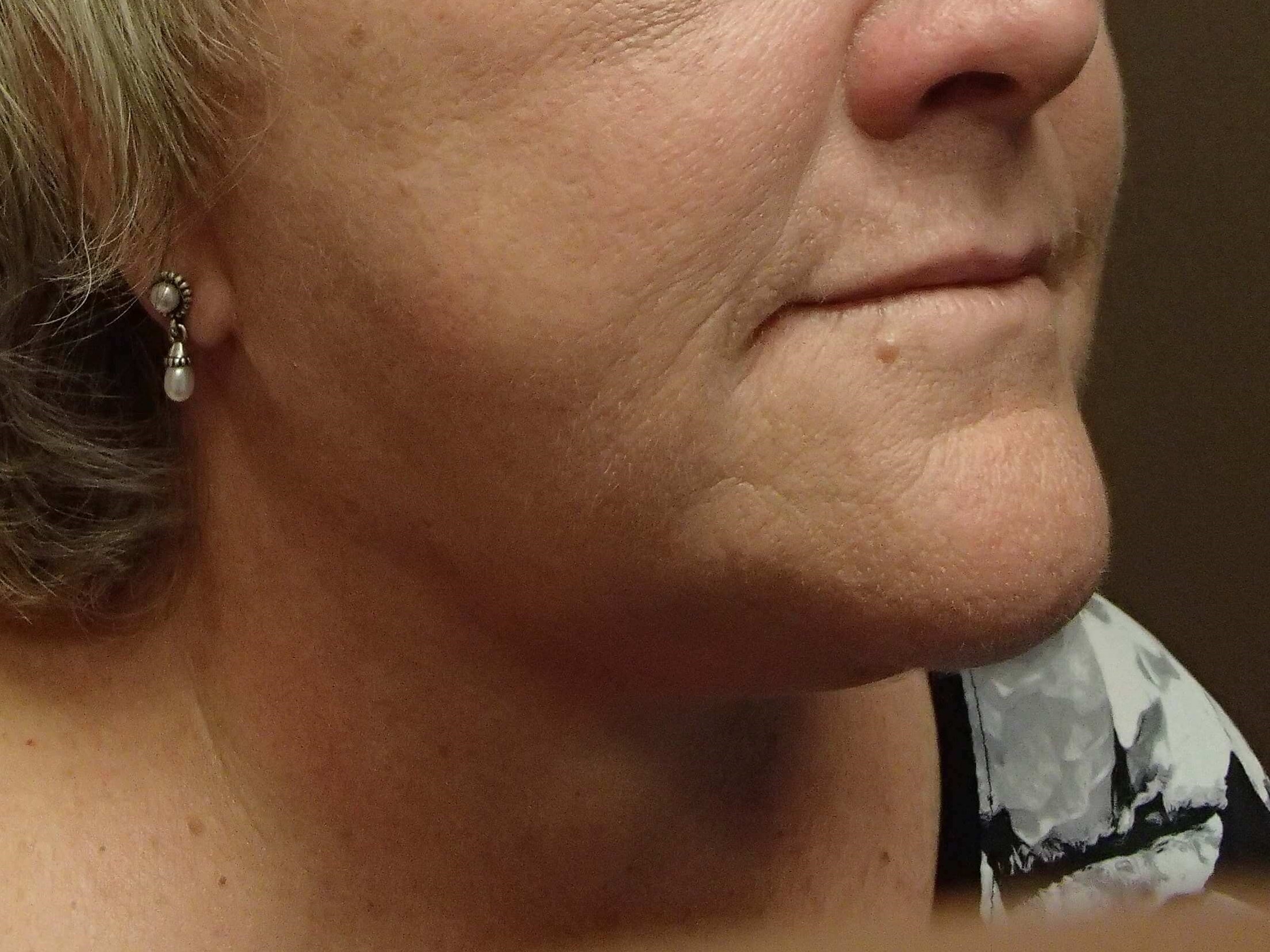 Facelift and Necklift After