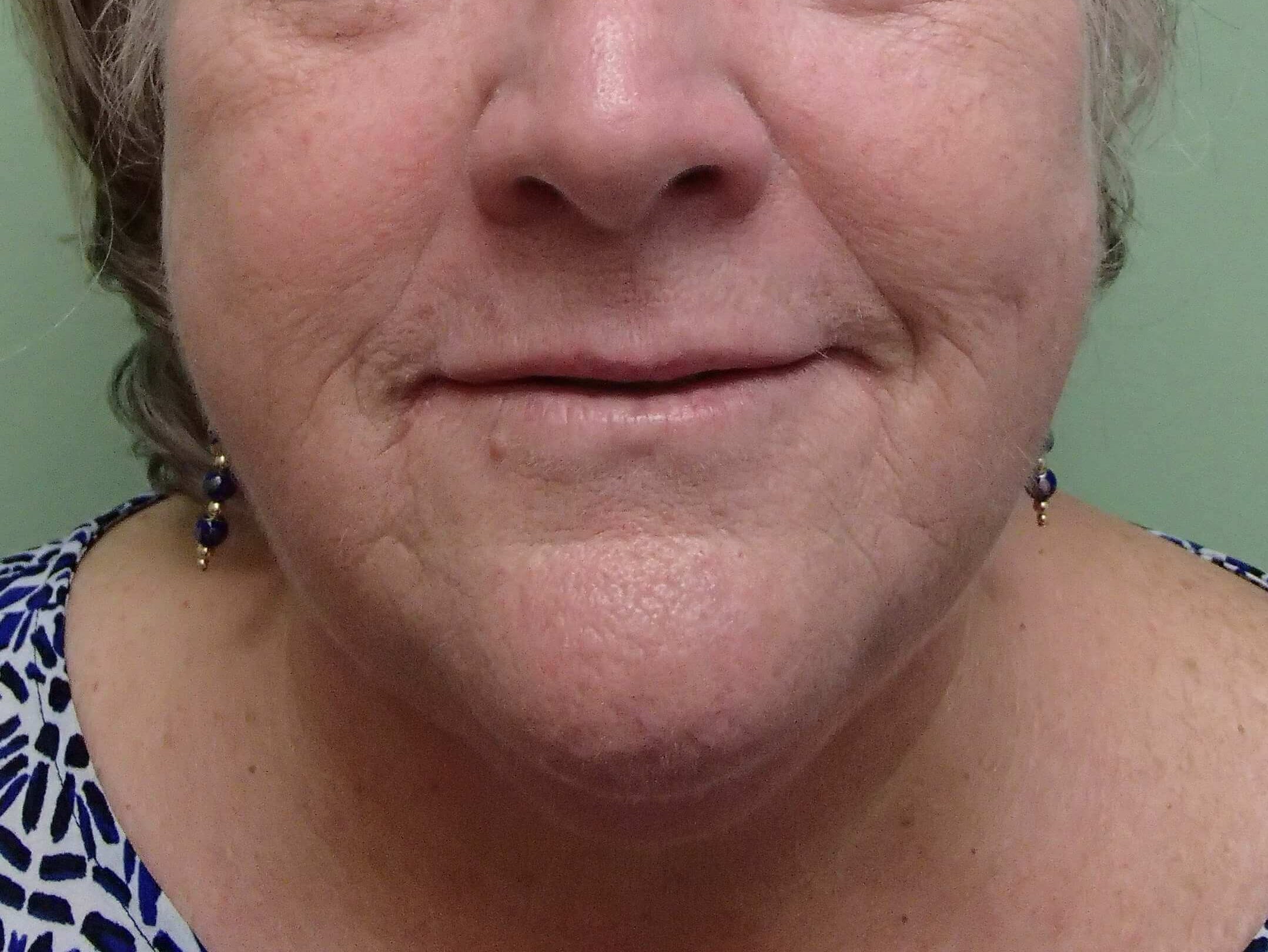 Facelift and Necklift Before