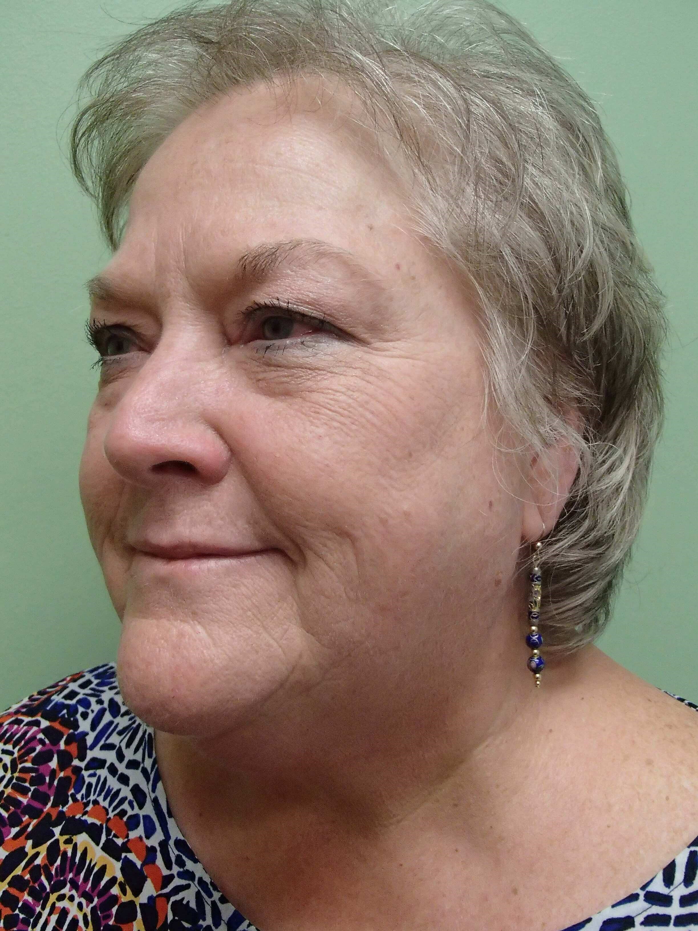 Facelift and Necklift Before