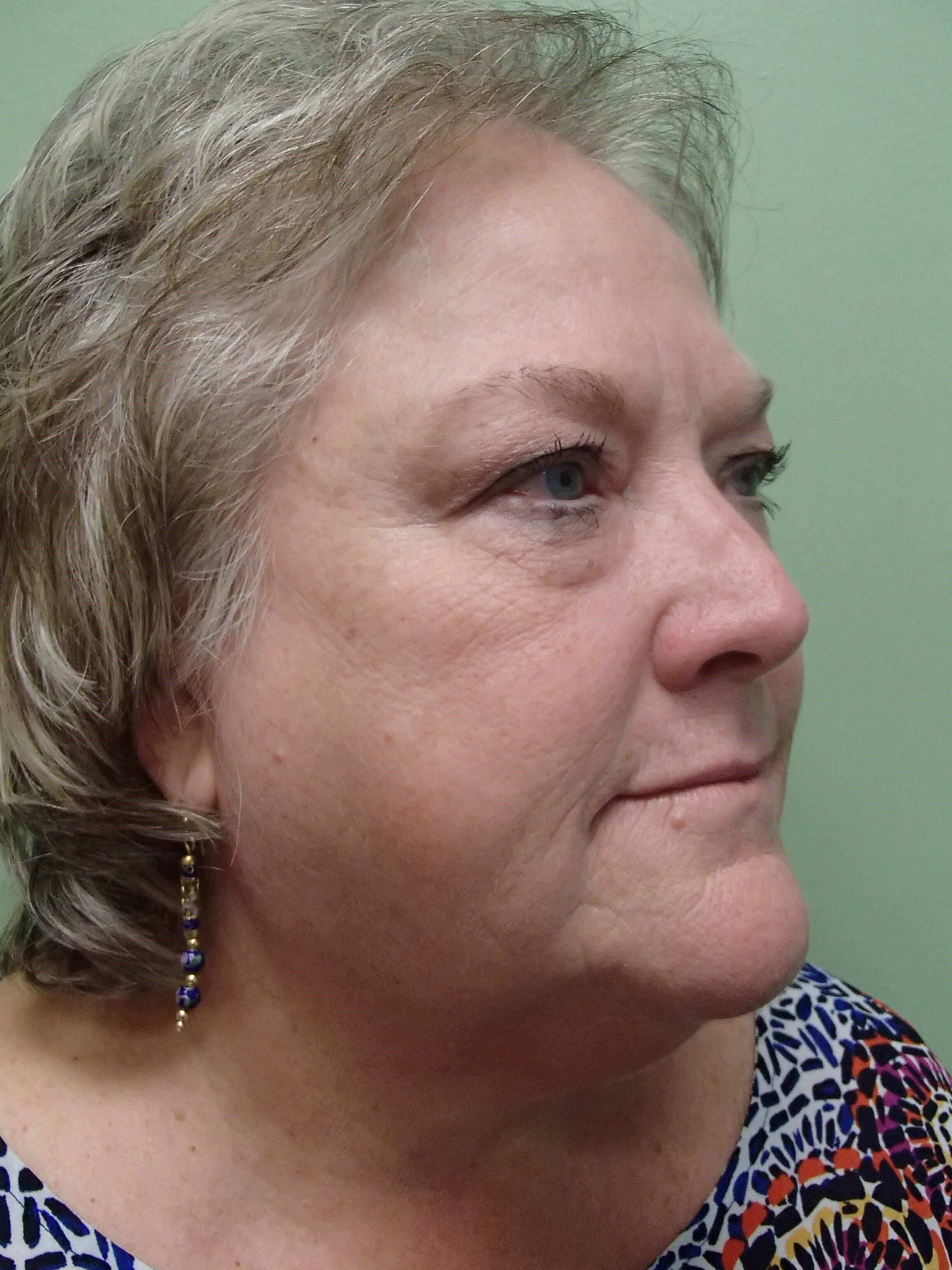 Facelift and Necklift Before