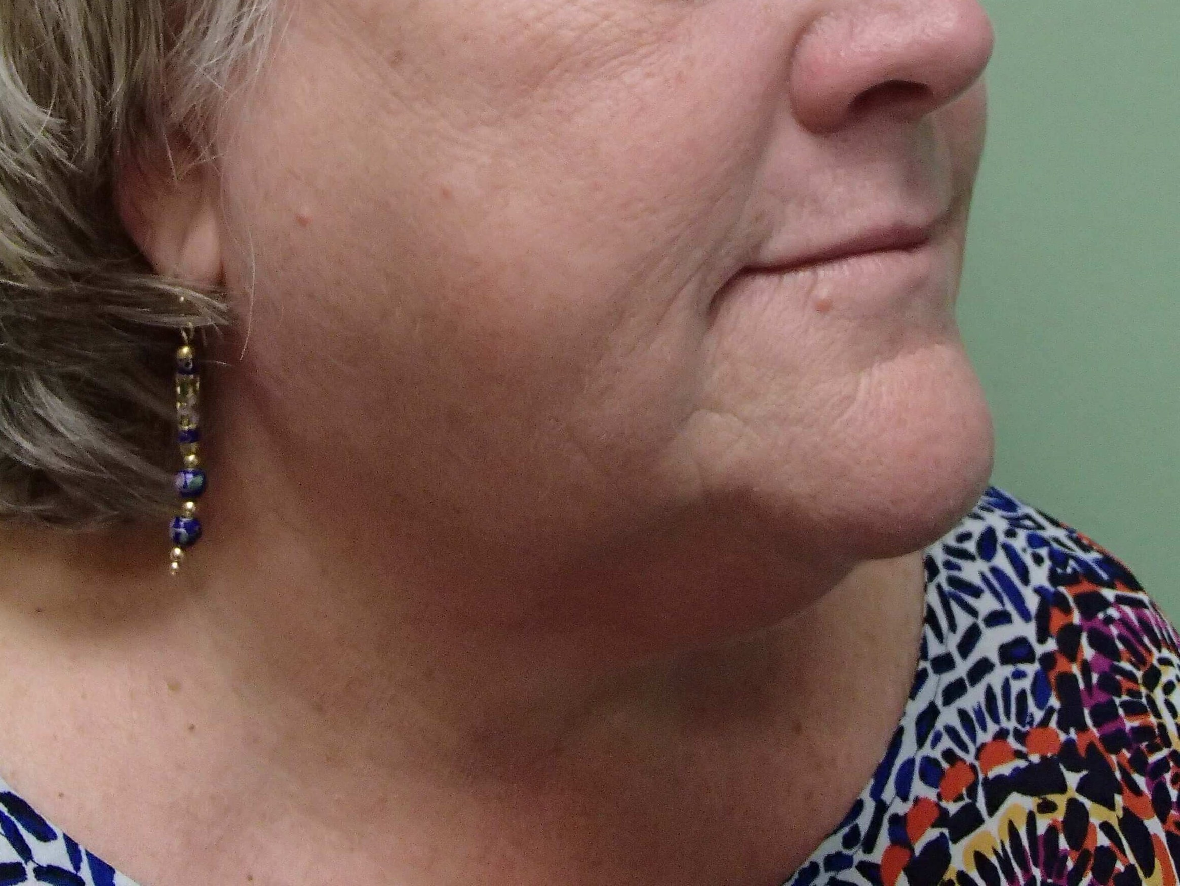 Facelift and Necklift Before