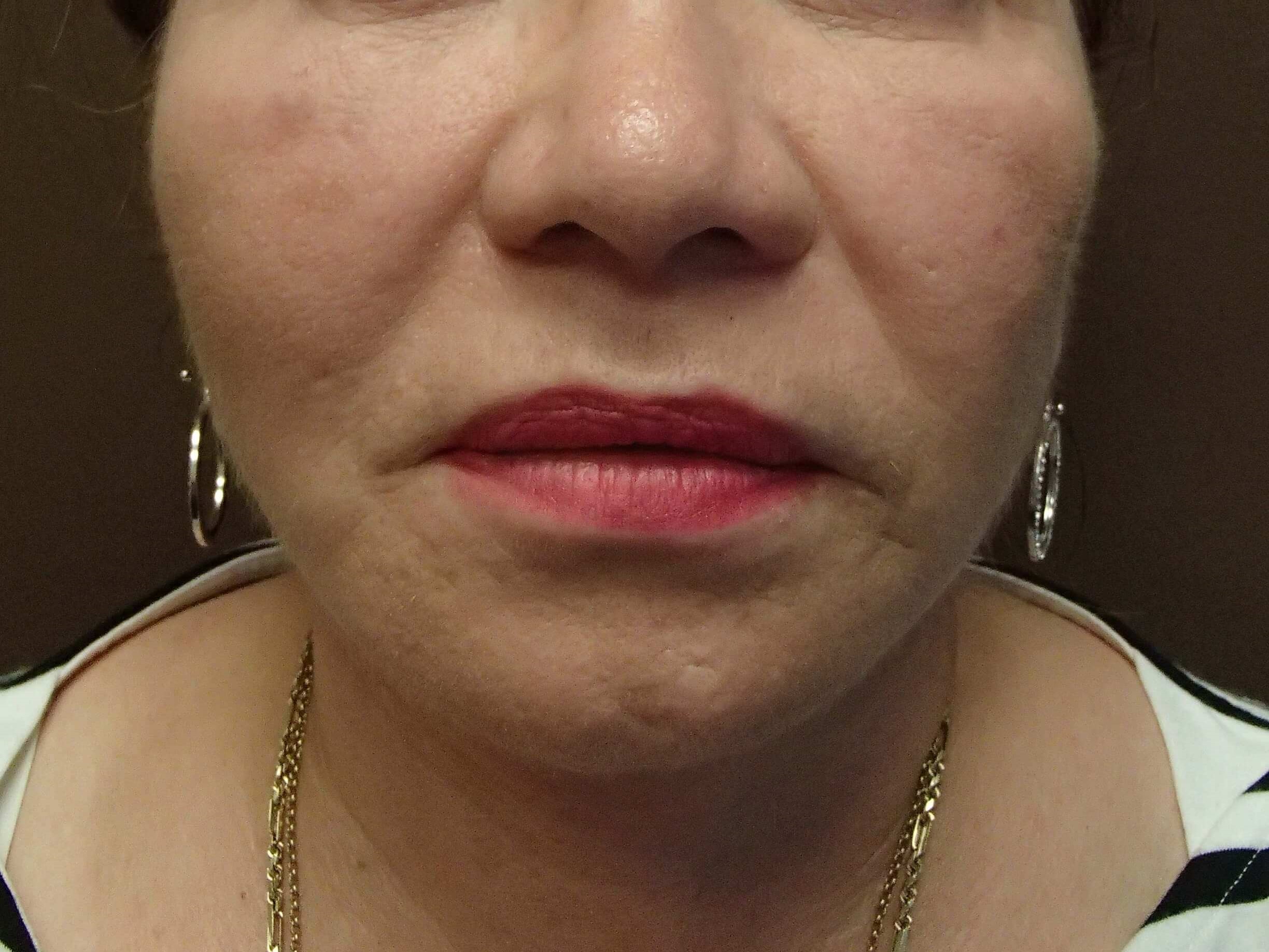 Facelift After