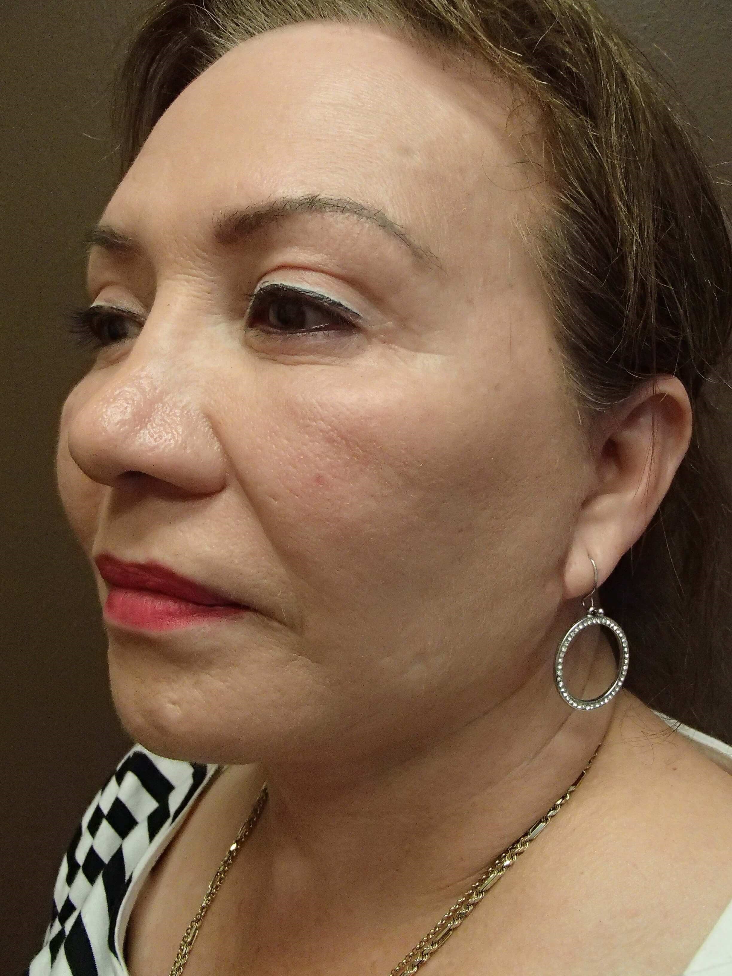 Facelift After