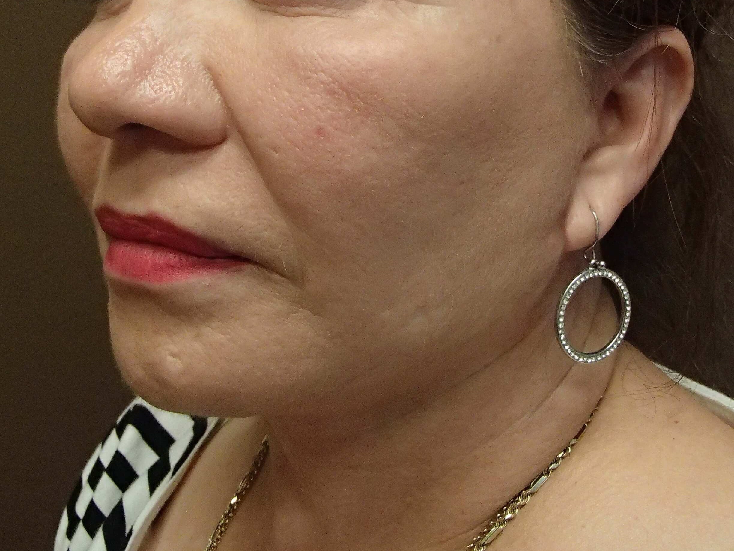 Facelift After