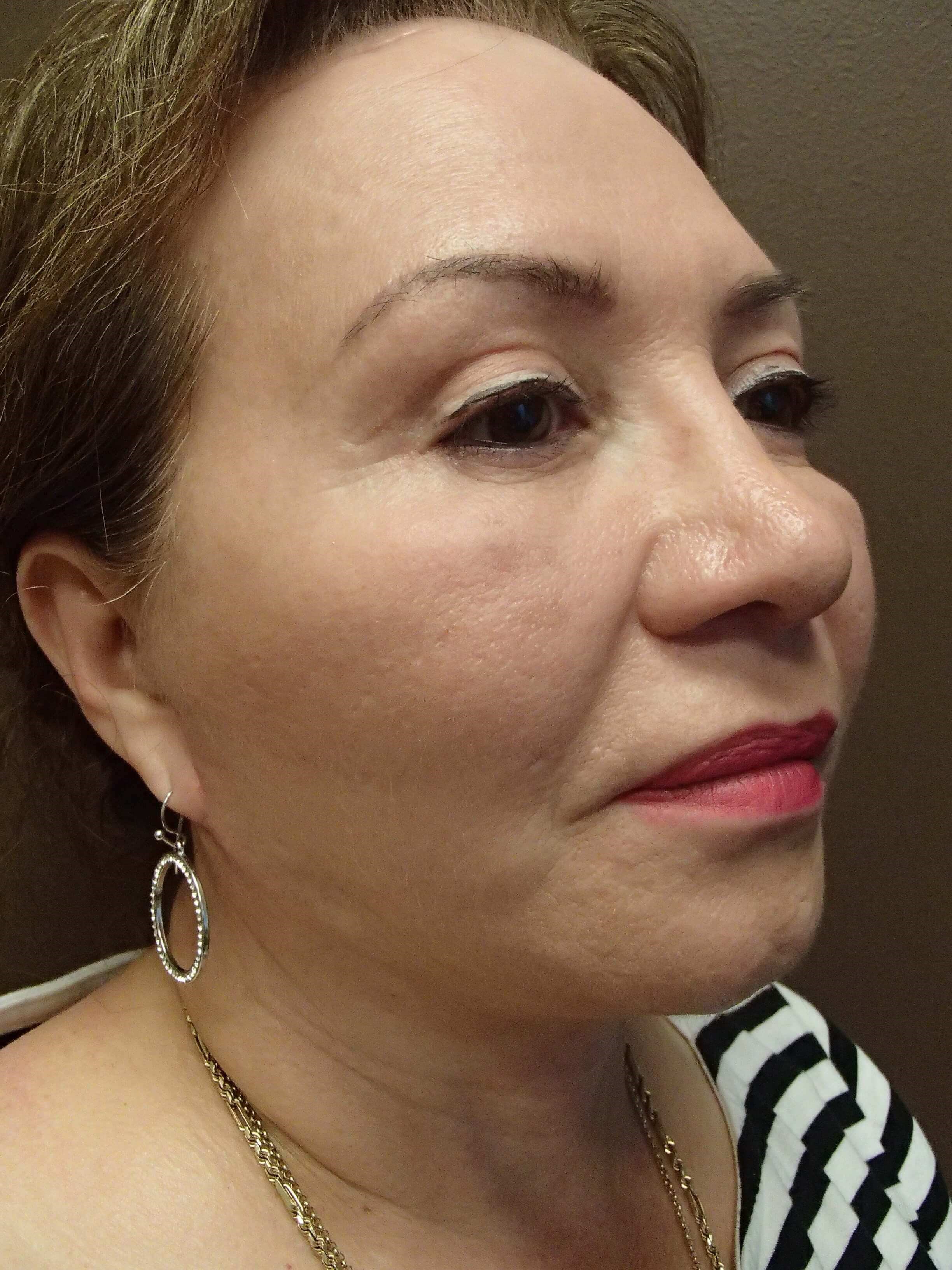 Facelift After