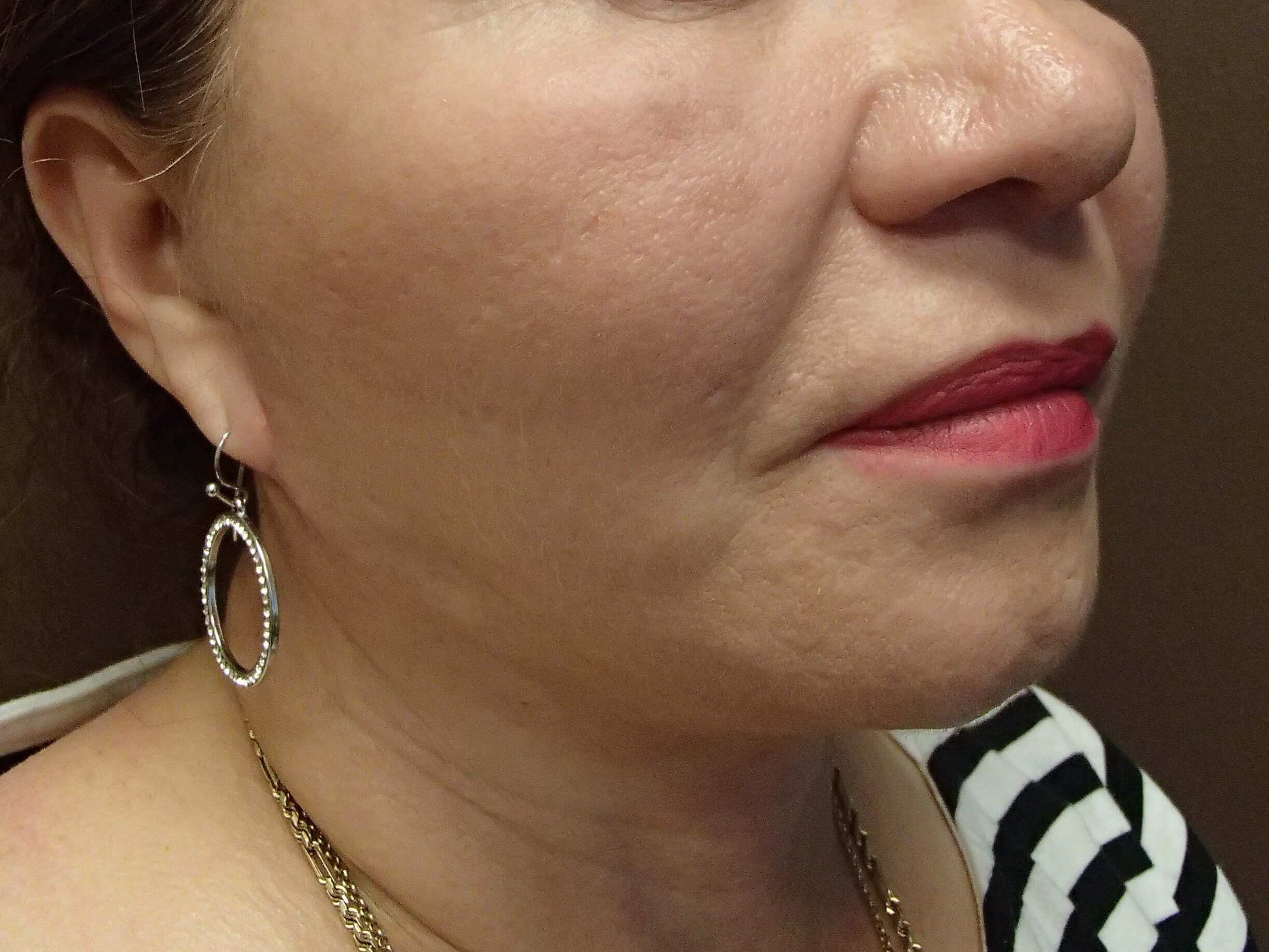 Facelift After