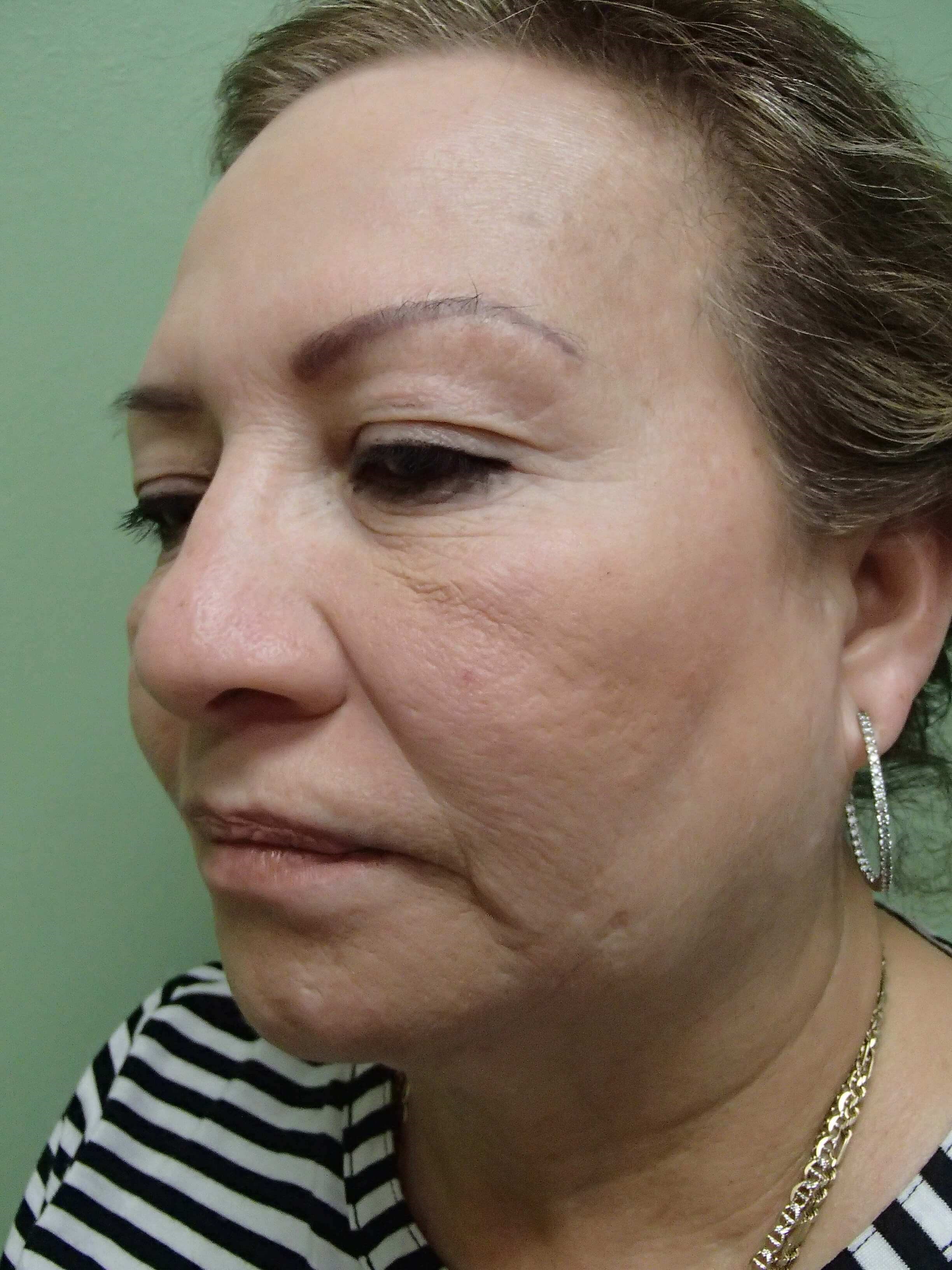 Facelift Before
