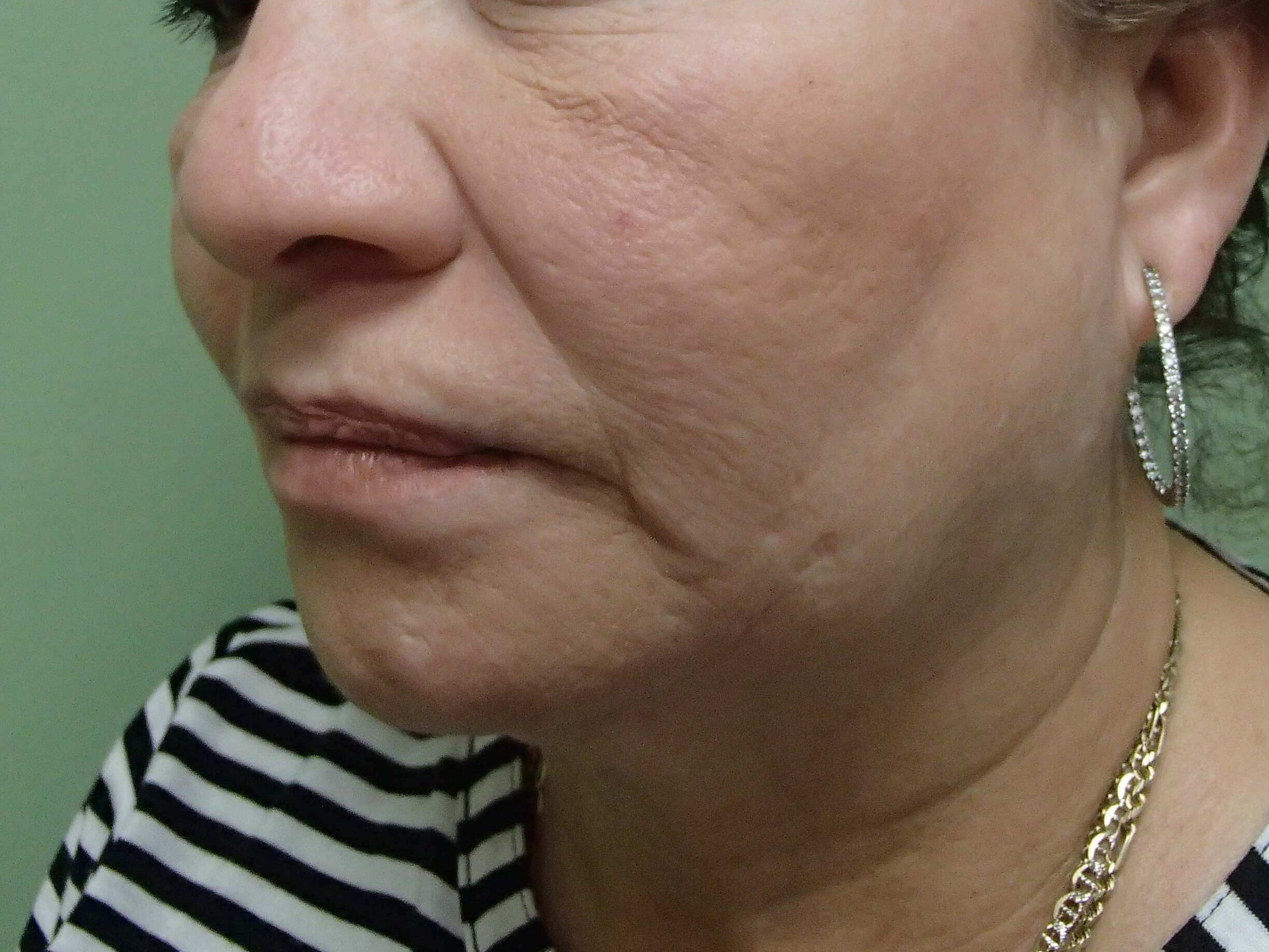 Facelift Before