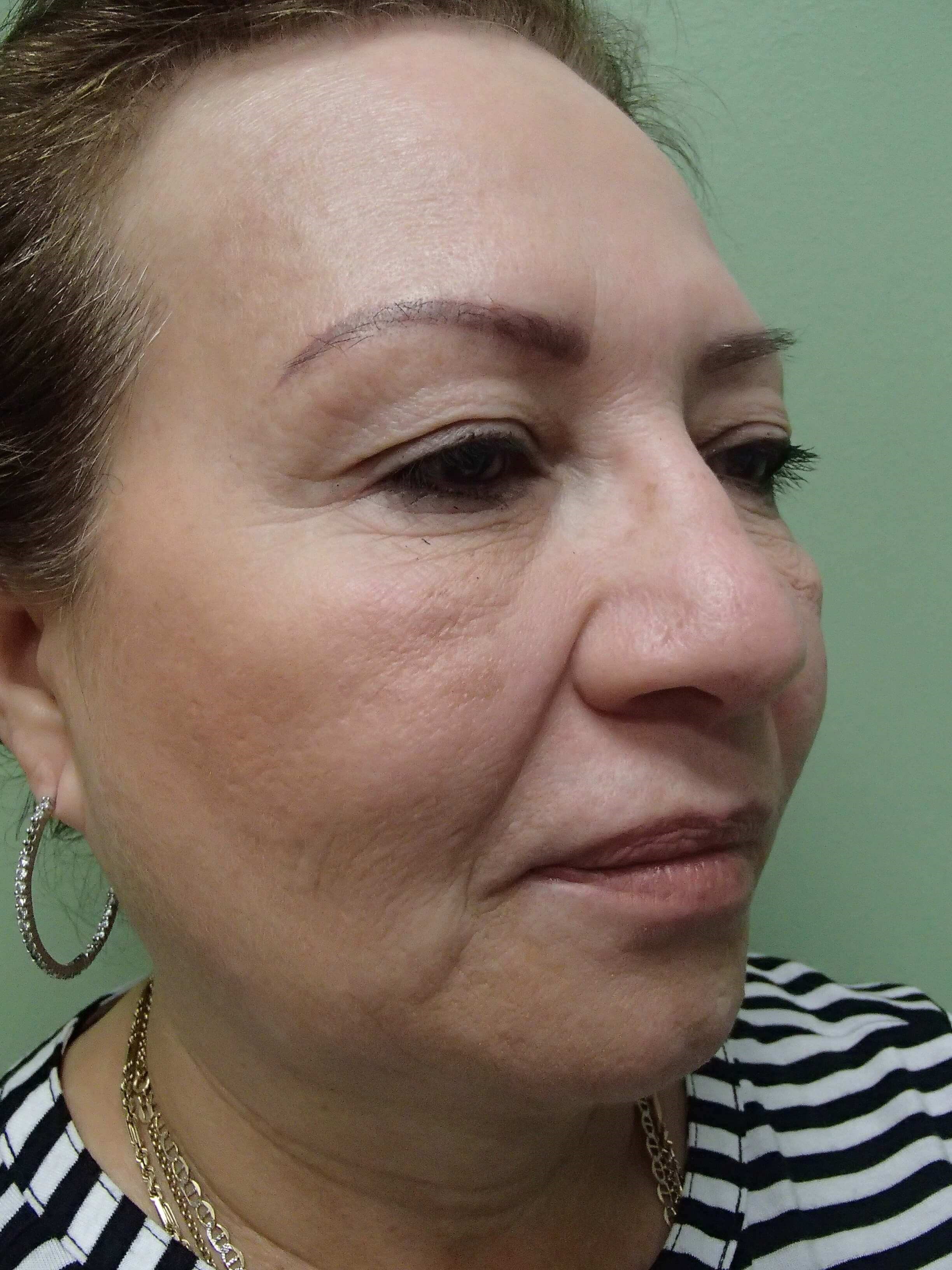 Facelift Before
