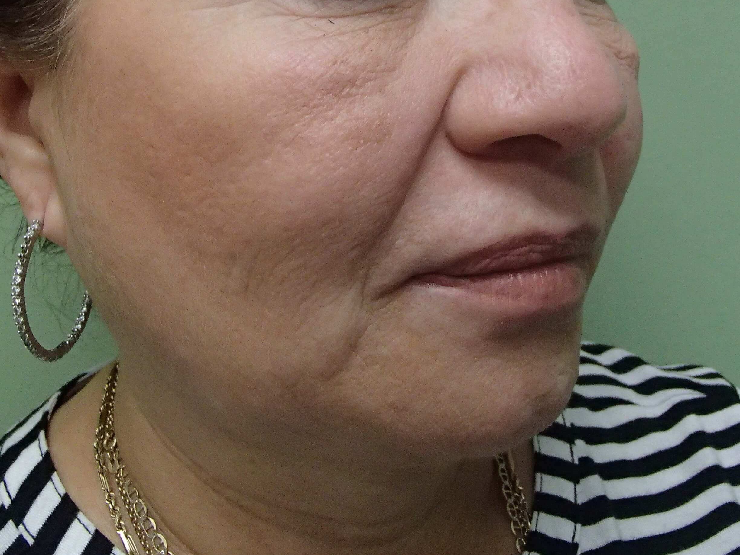 Facelift Before
