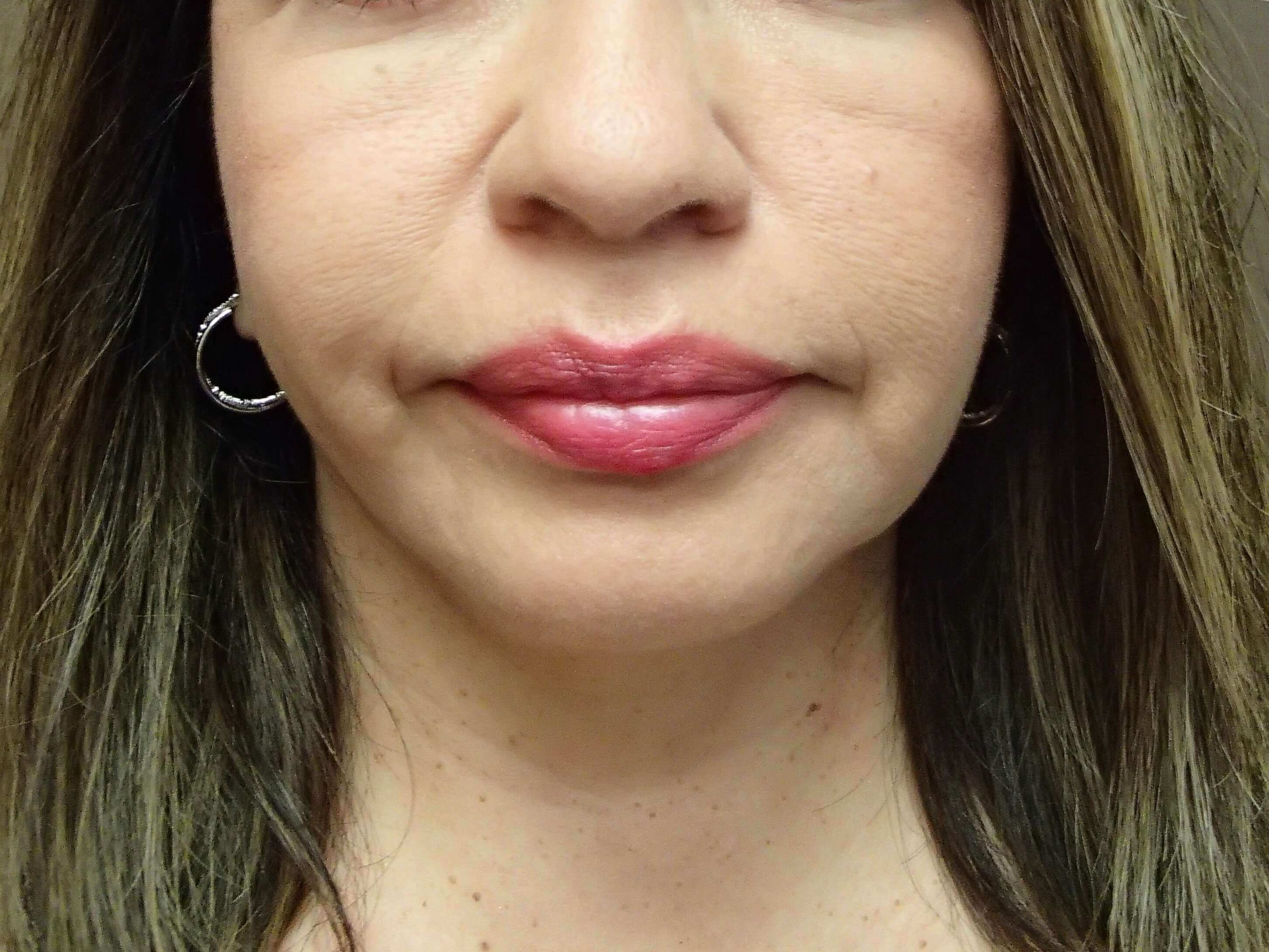 Facelift After