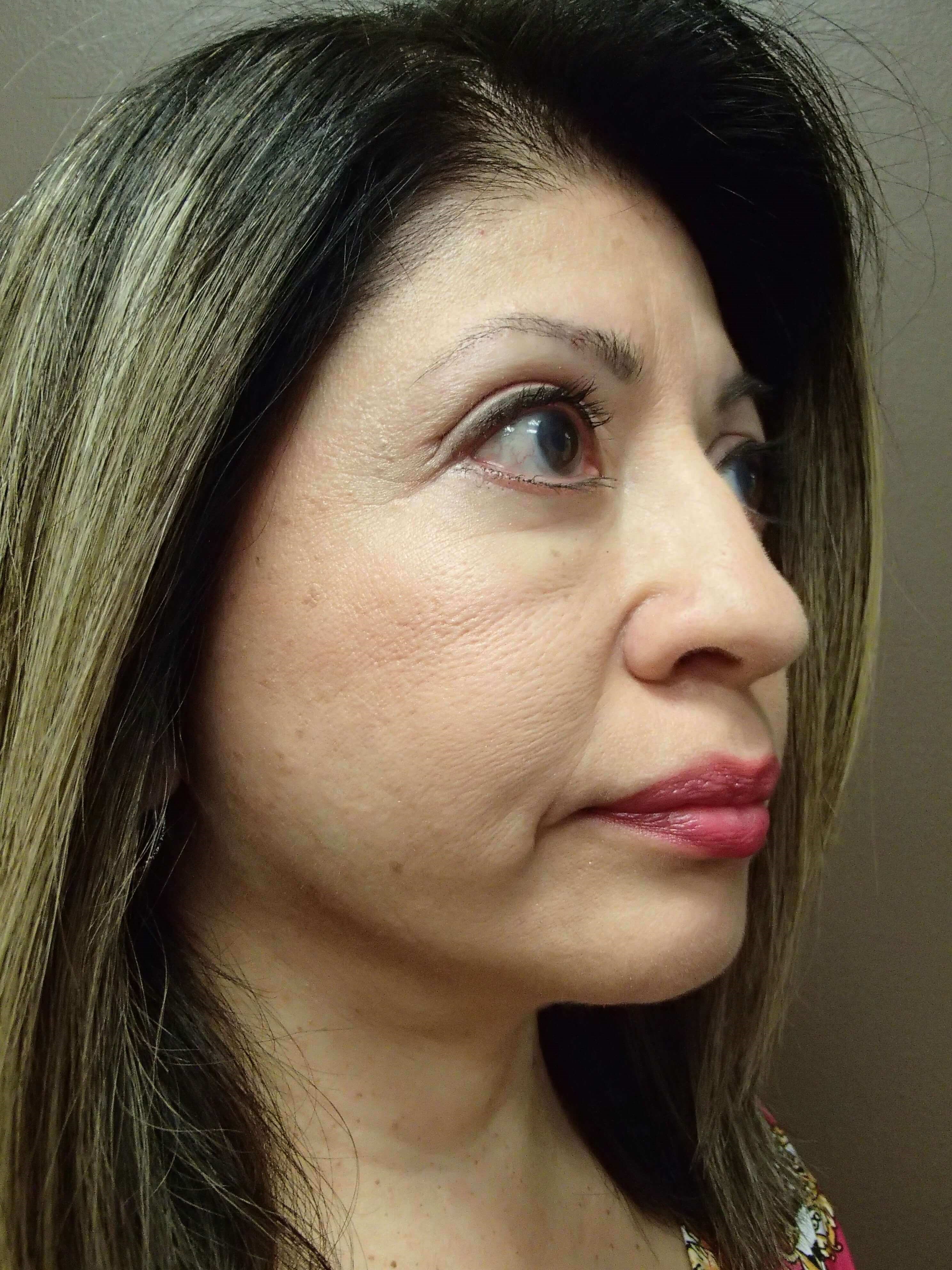 Facelift After
