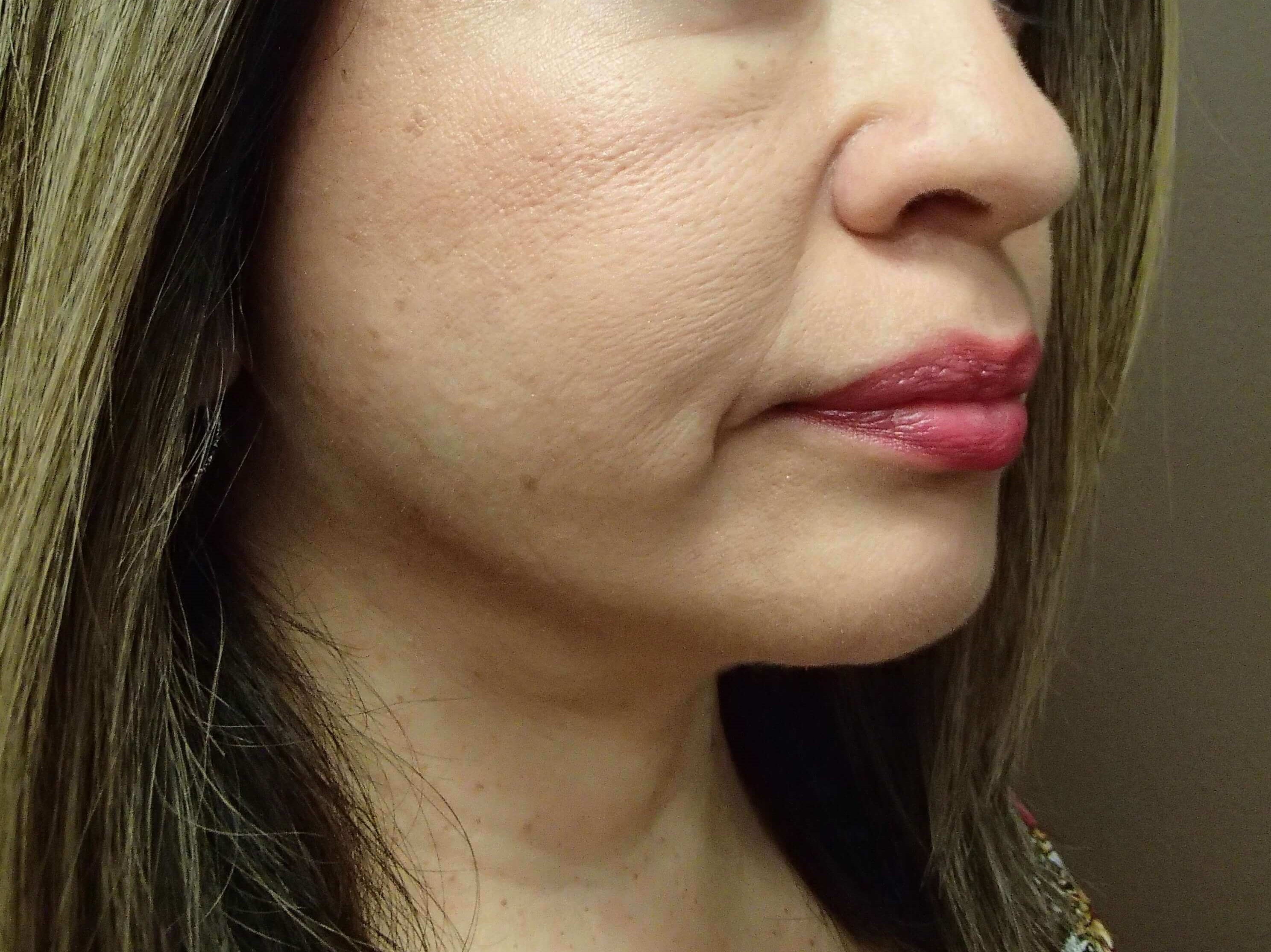 Facelift After