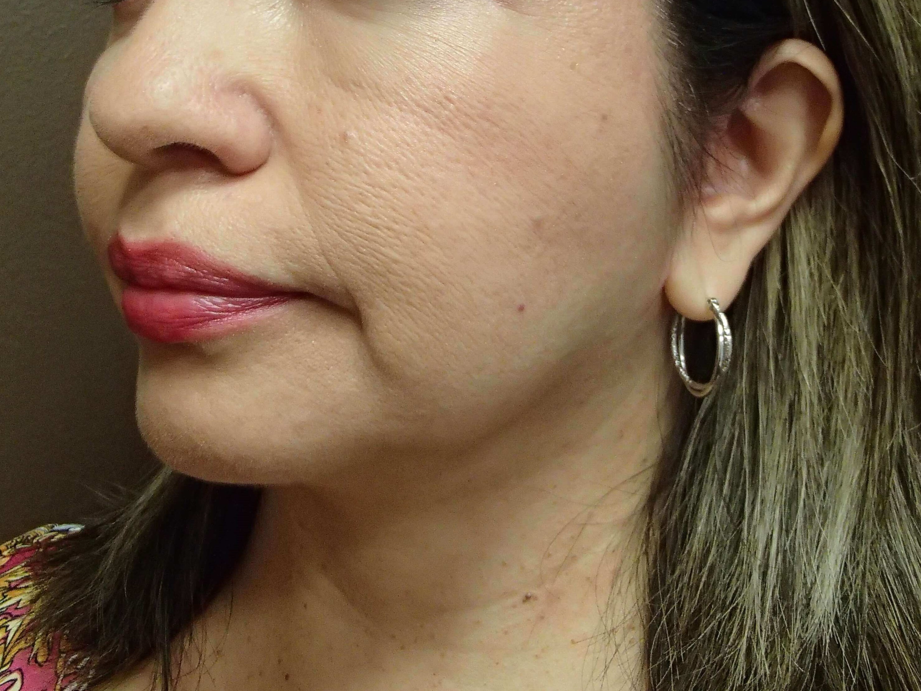 Facelift After