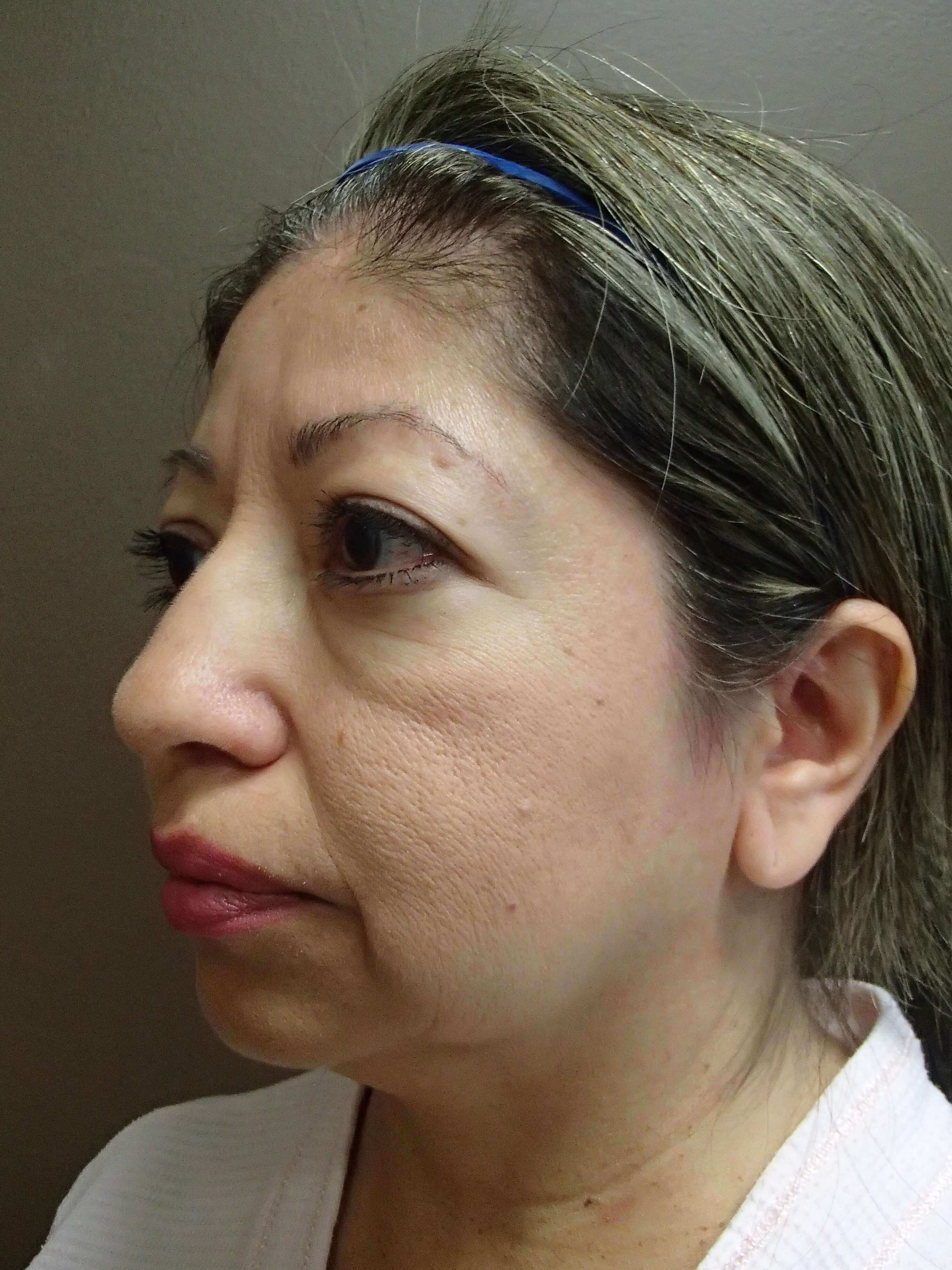 Facelift Before
