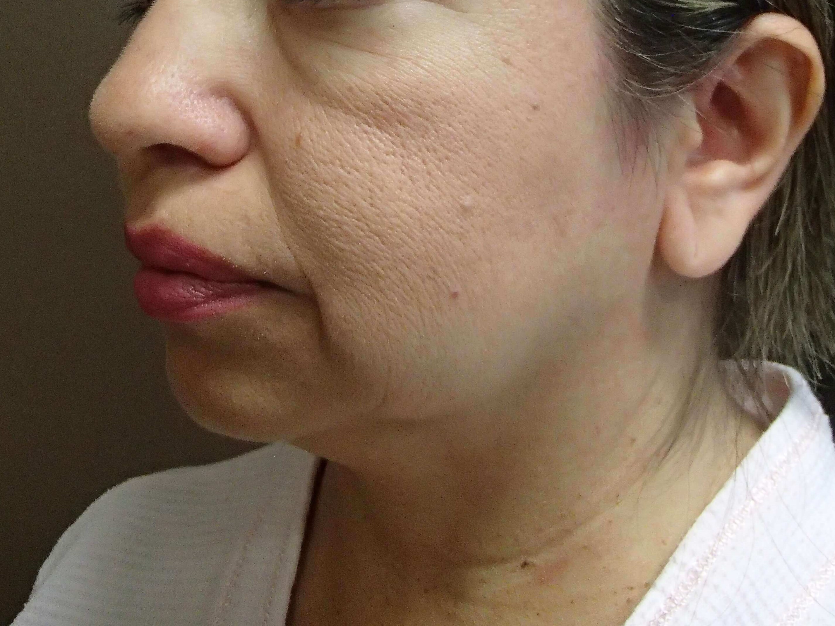 Facelift Before