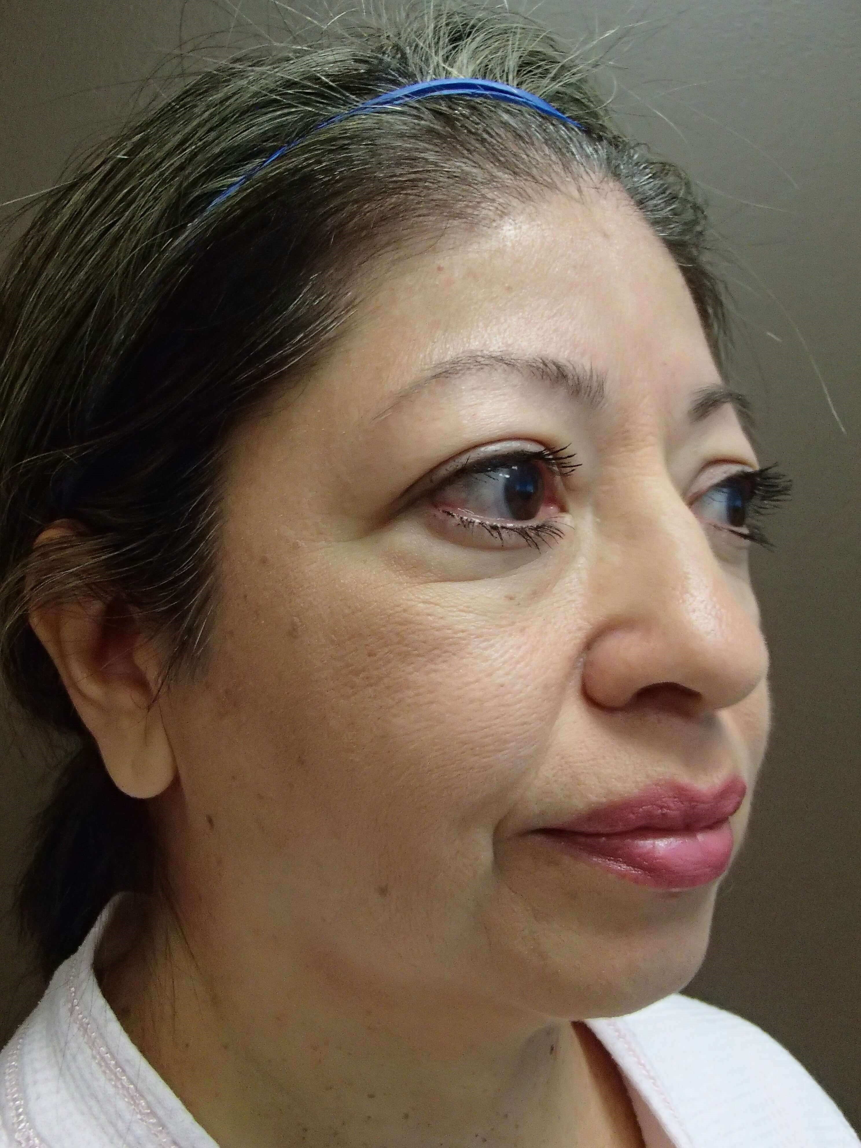 Facelift Before