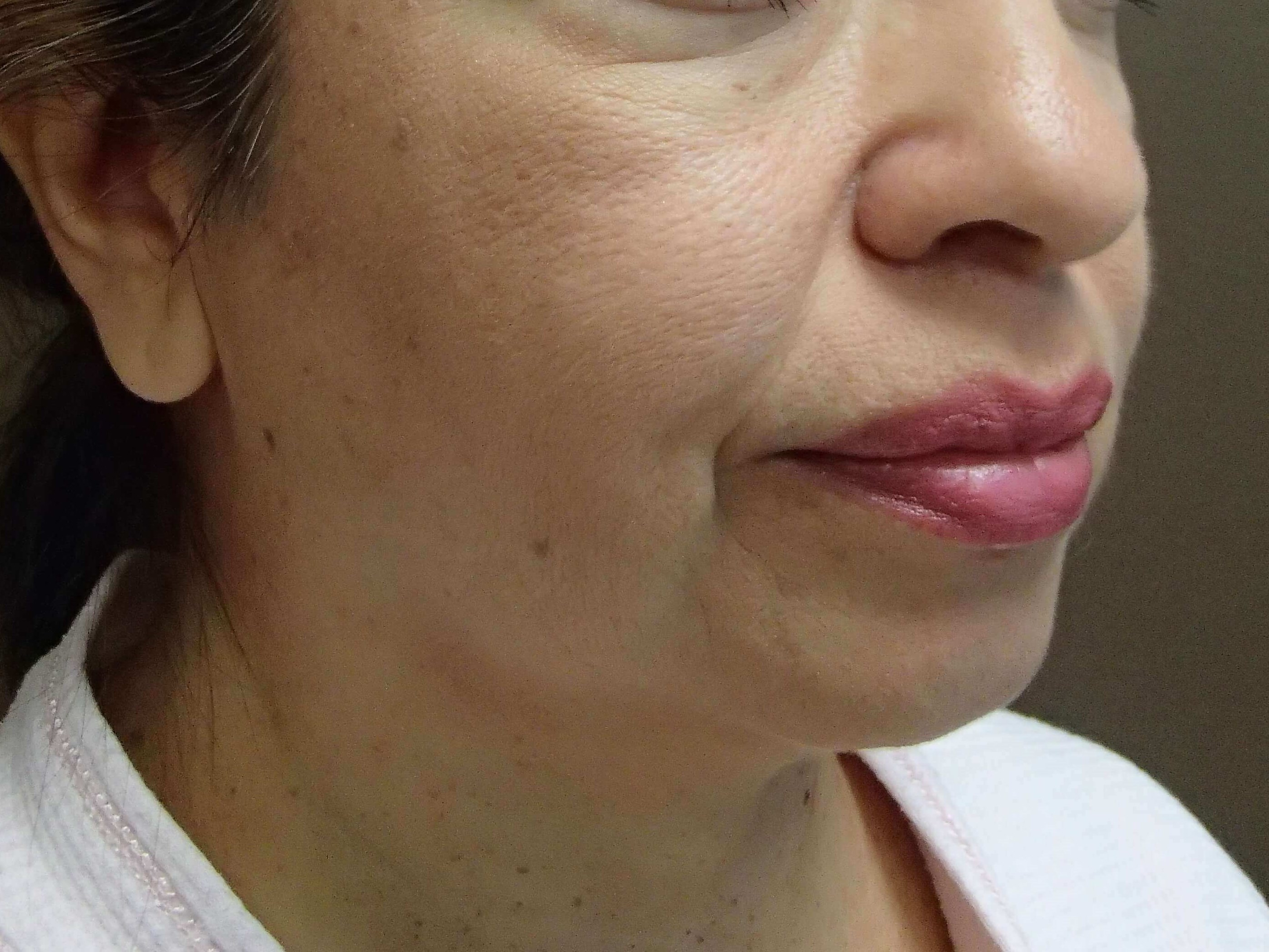 Facelift Before