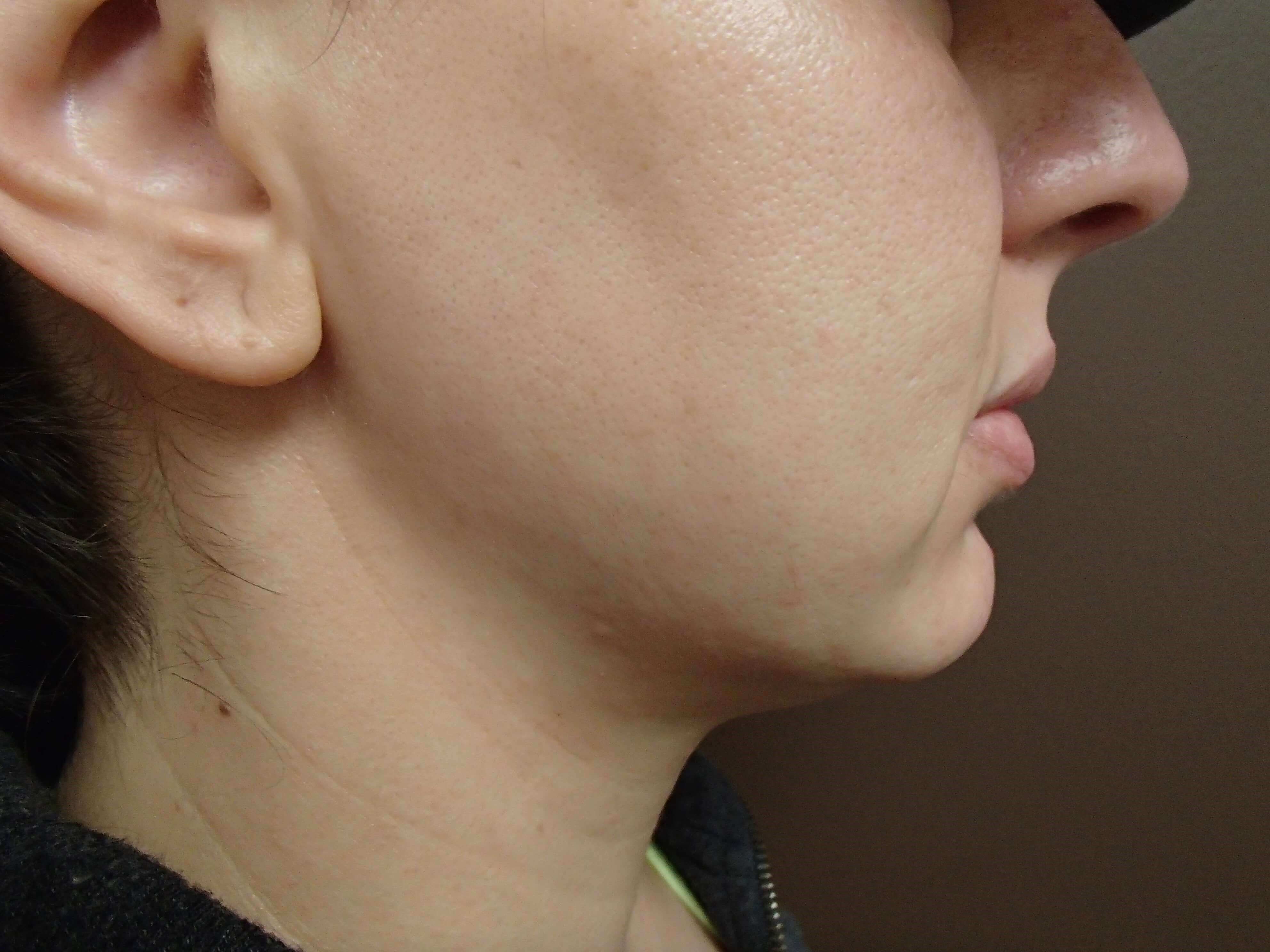 Ultherapy Full Face After