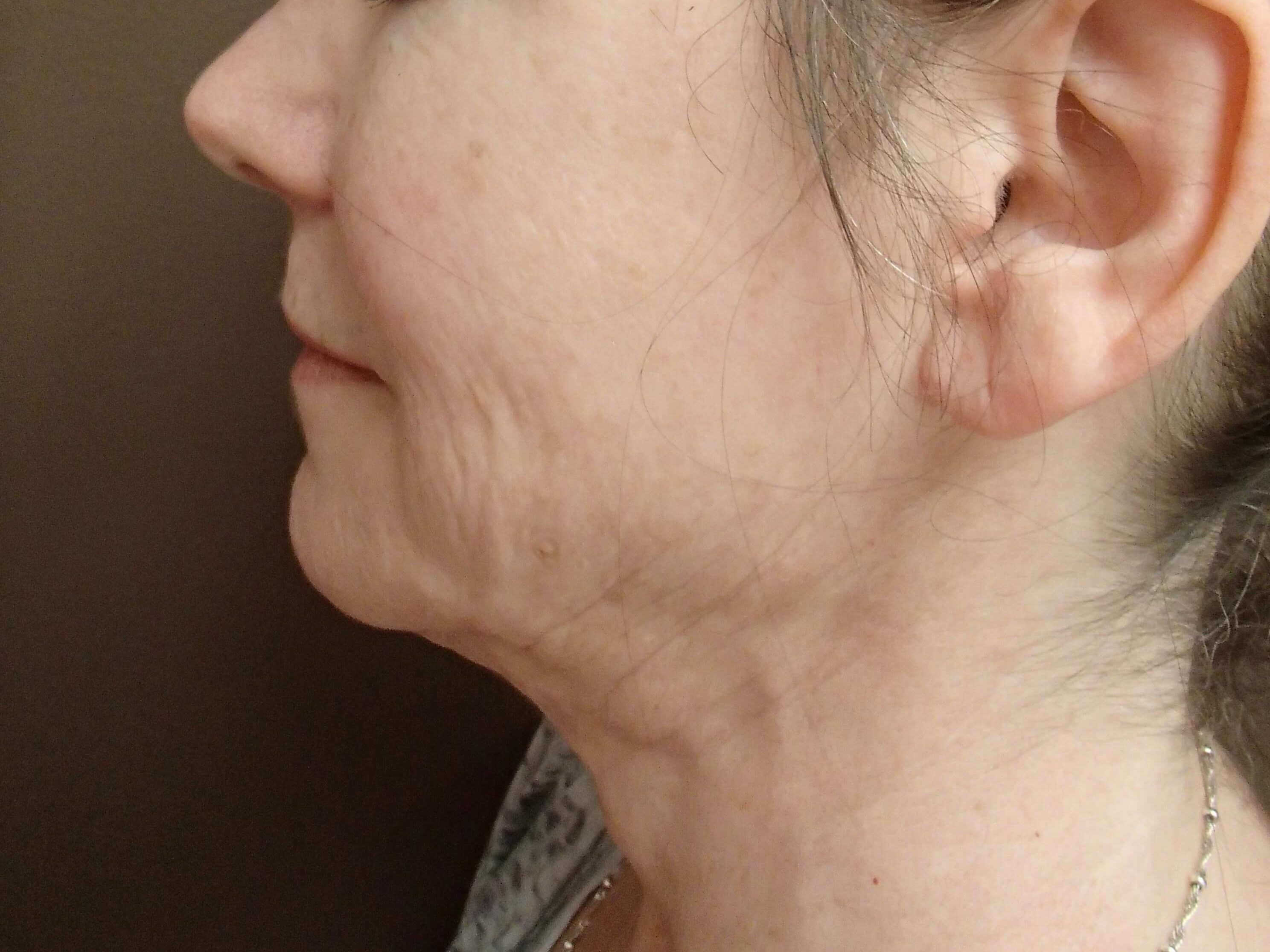 Ultherapy Lower Face and Neck Before