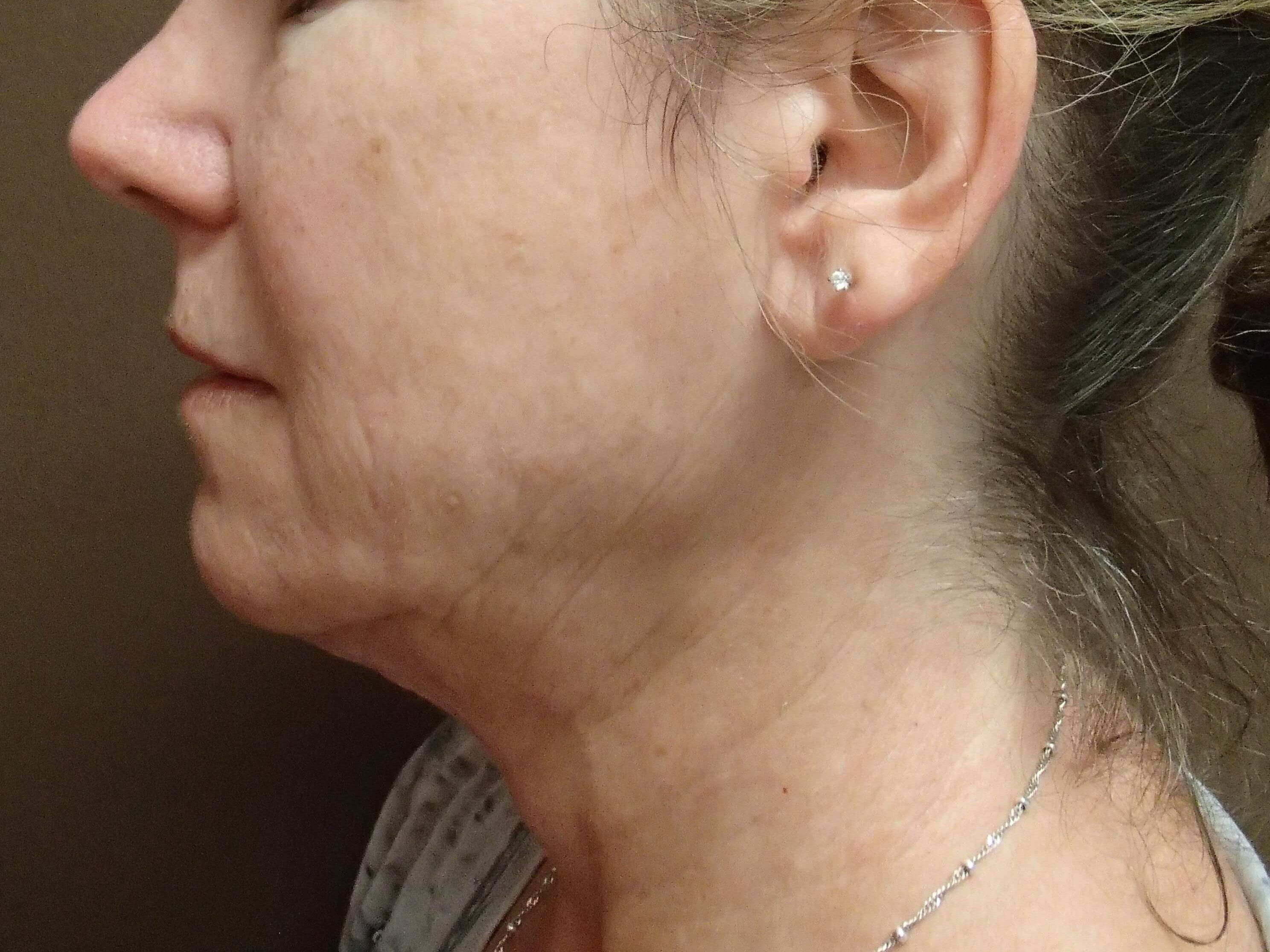 Ultherapy Lower Face and Neck After