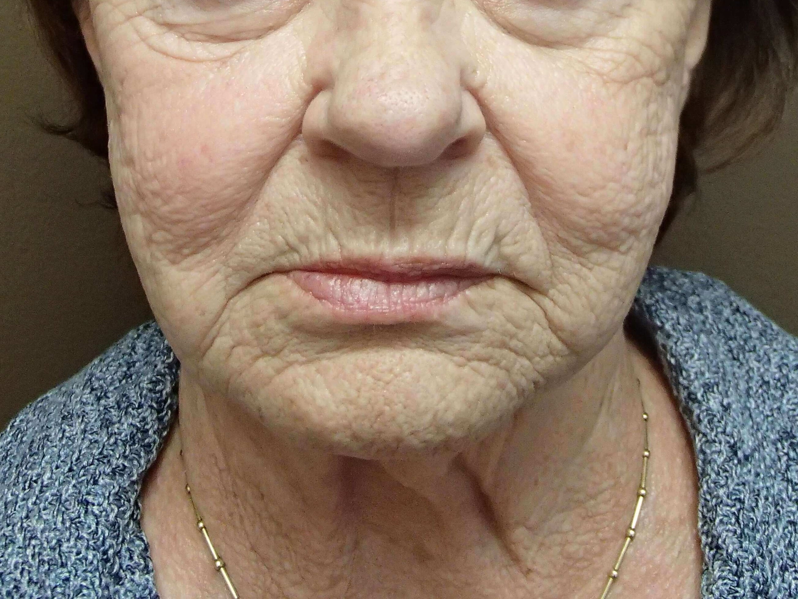 Facelift and Necklift Before