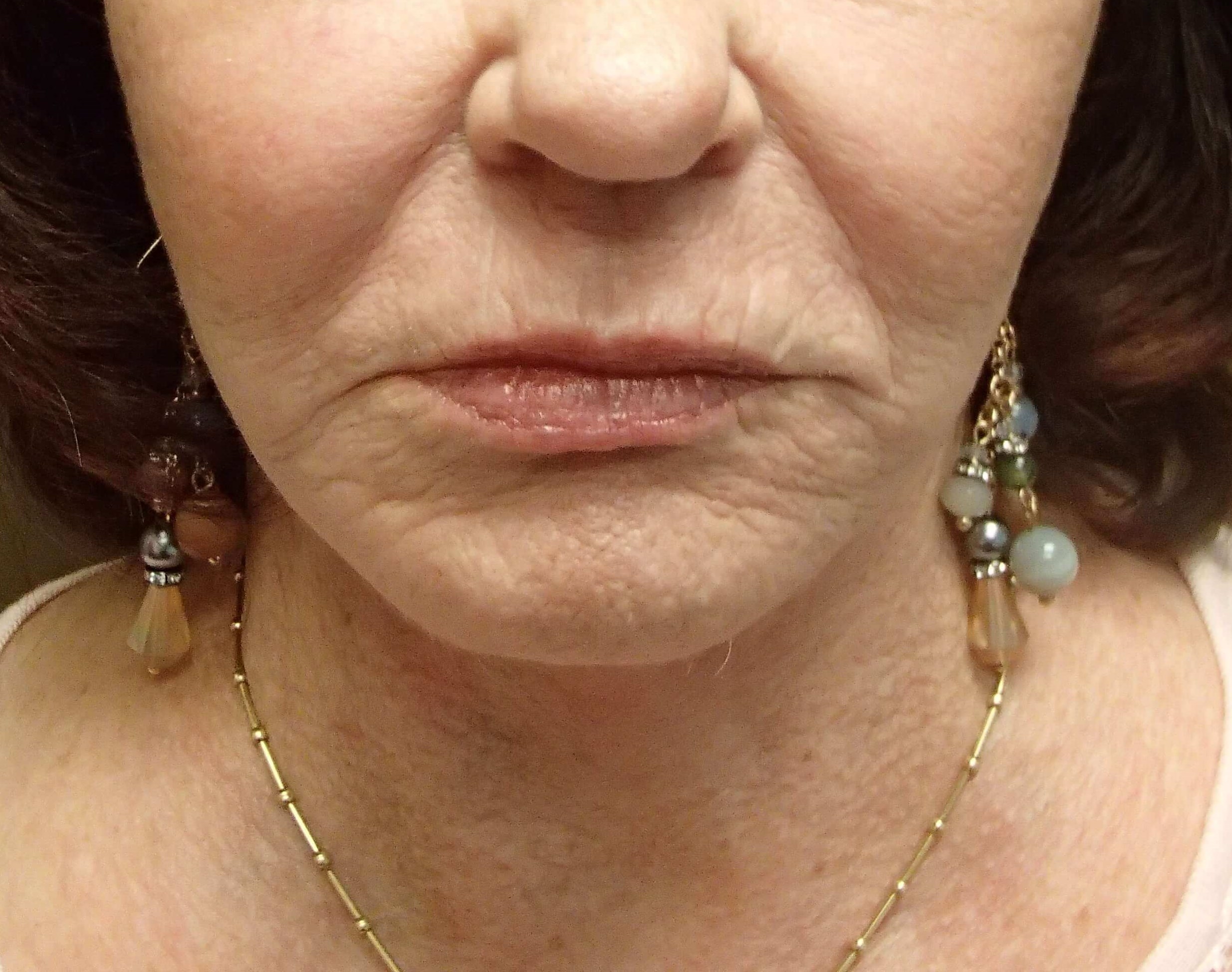Facelift and Necklift After