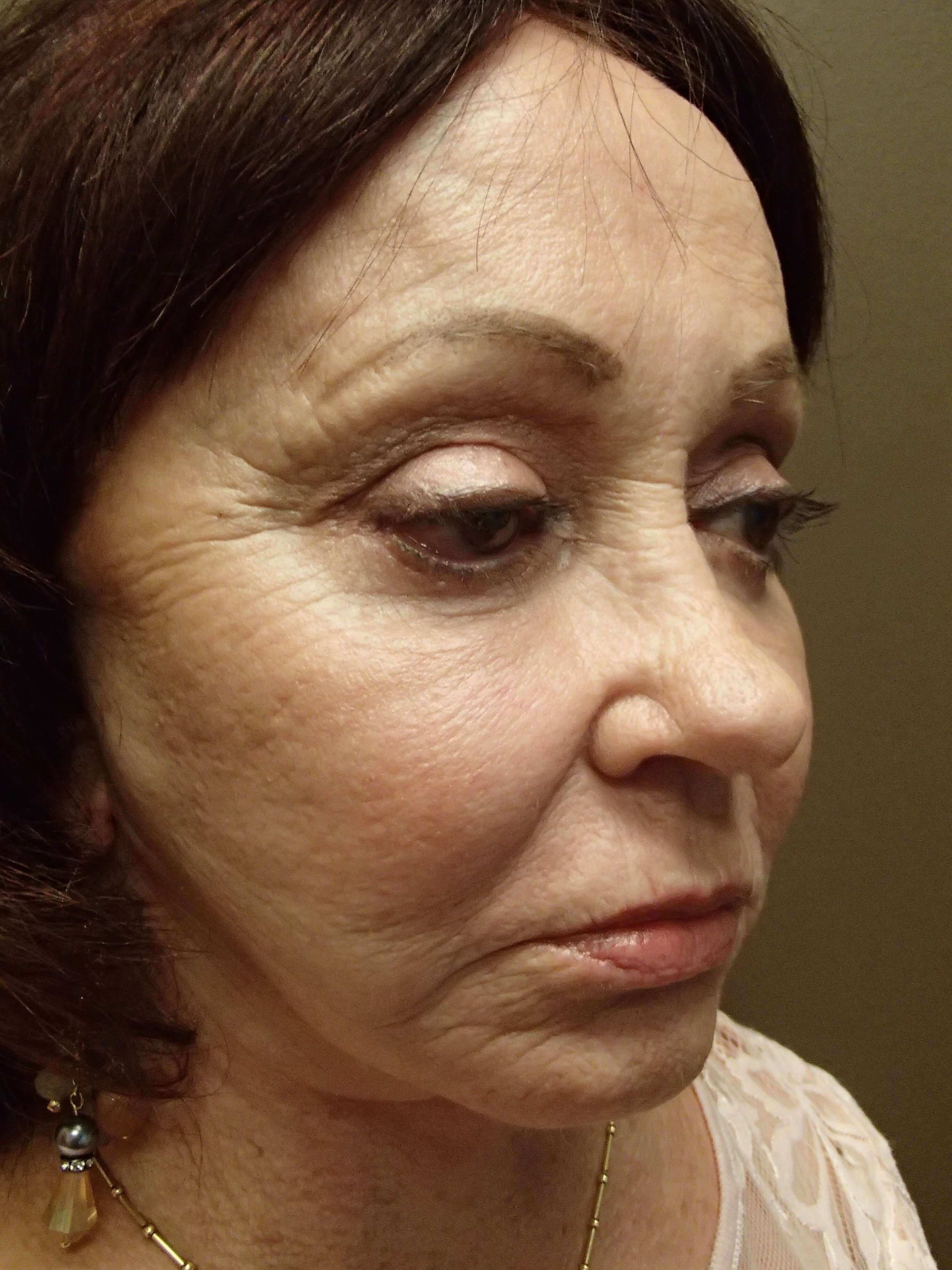 Facelift and Necklift After