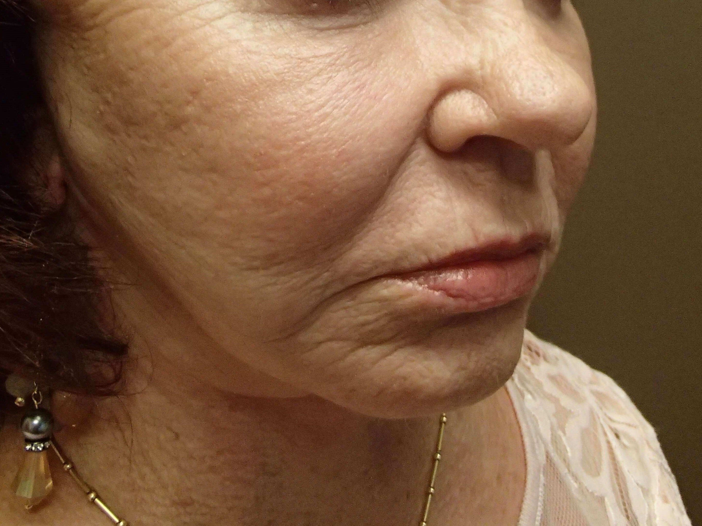Facelift and Necklift After