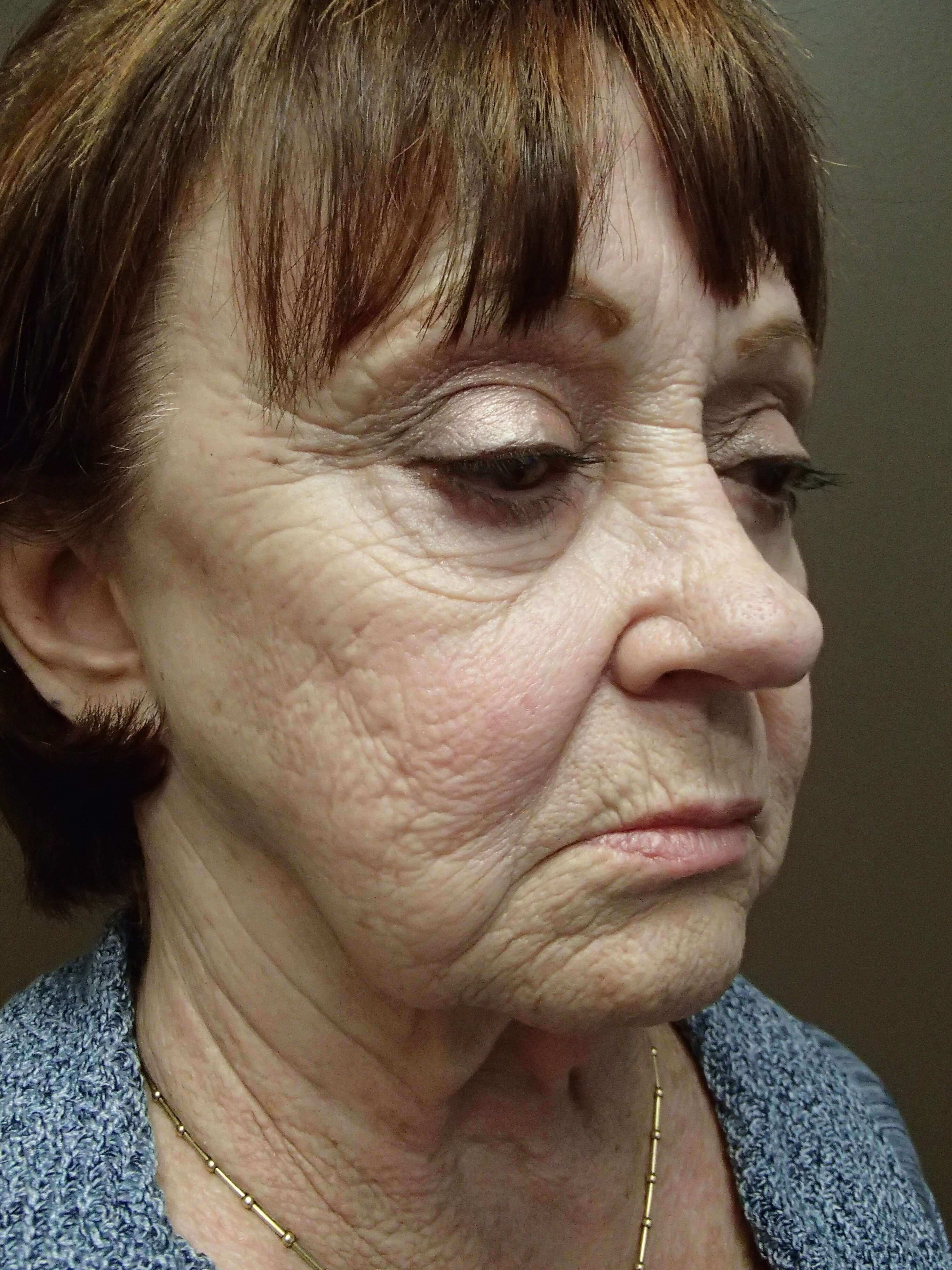 Facelift and Necklift Before