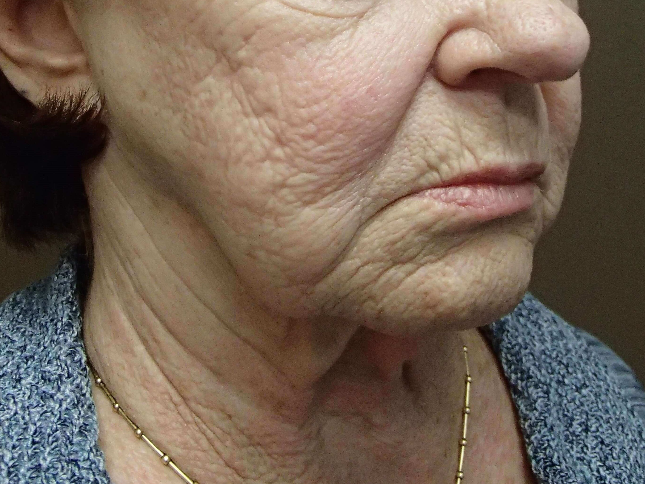 Facelift and Necklift Before