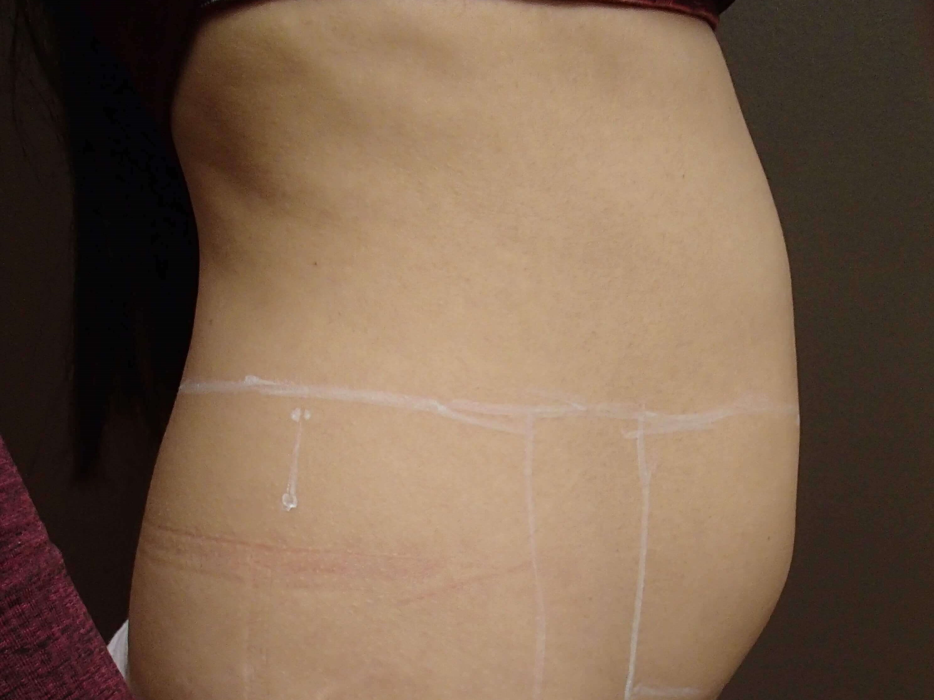 Trusculpt 3D Before