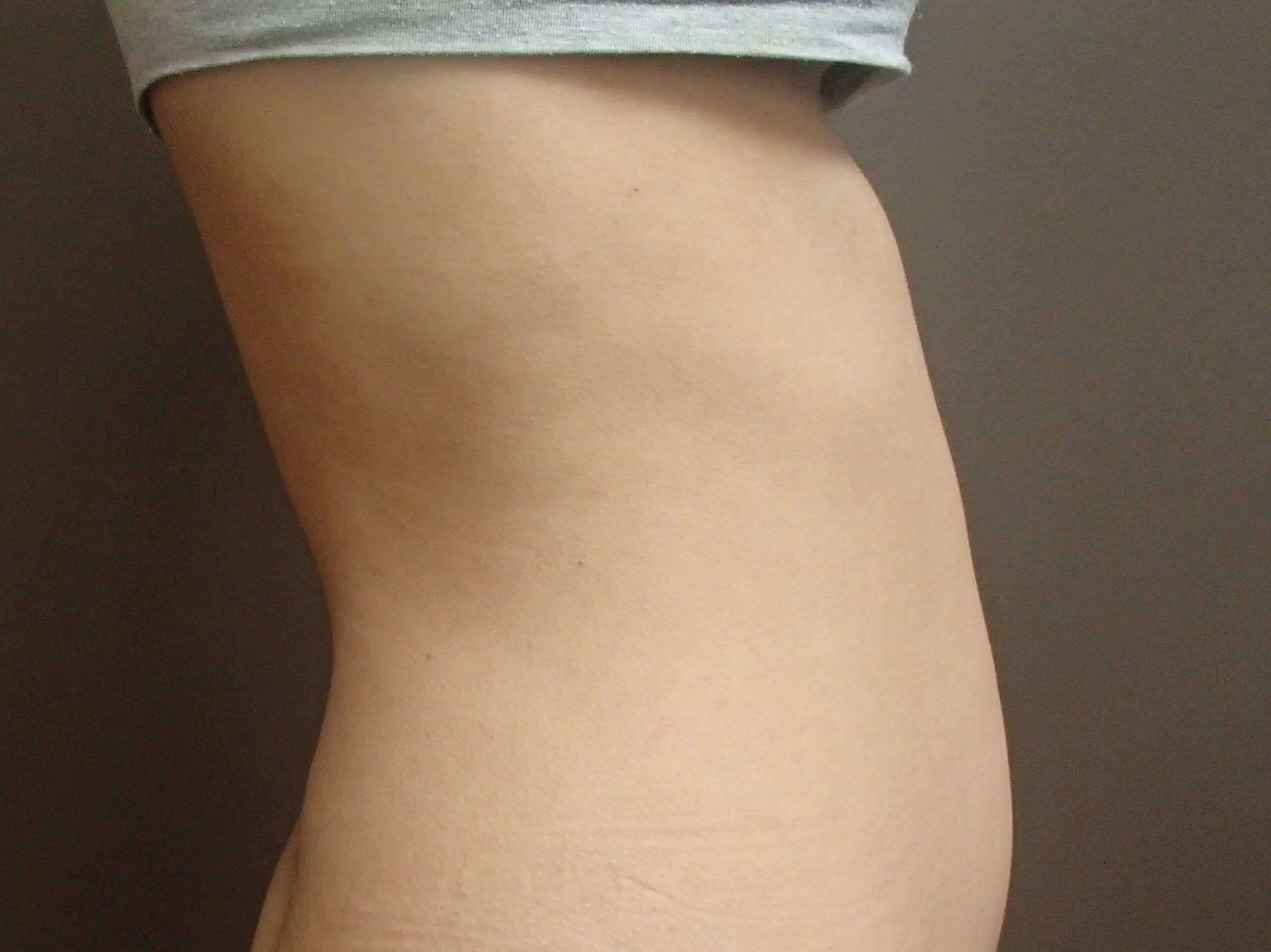 Trusculpt 3D After