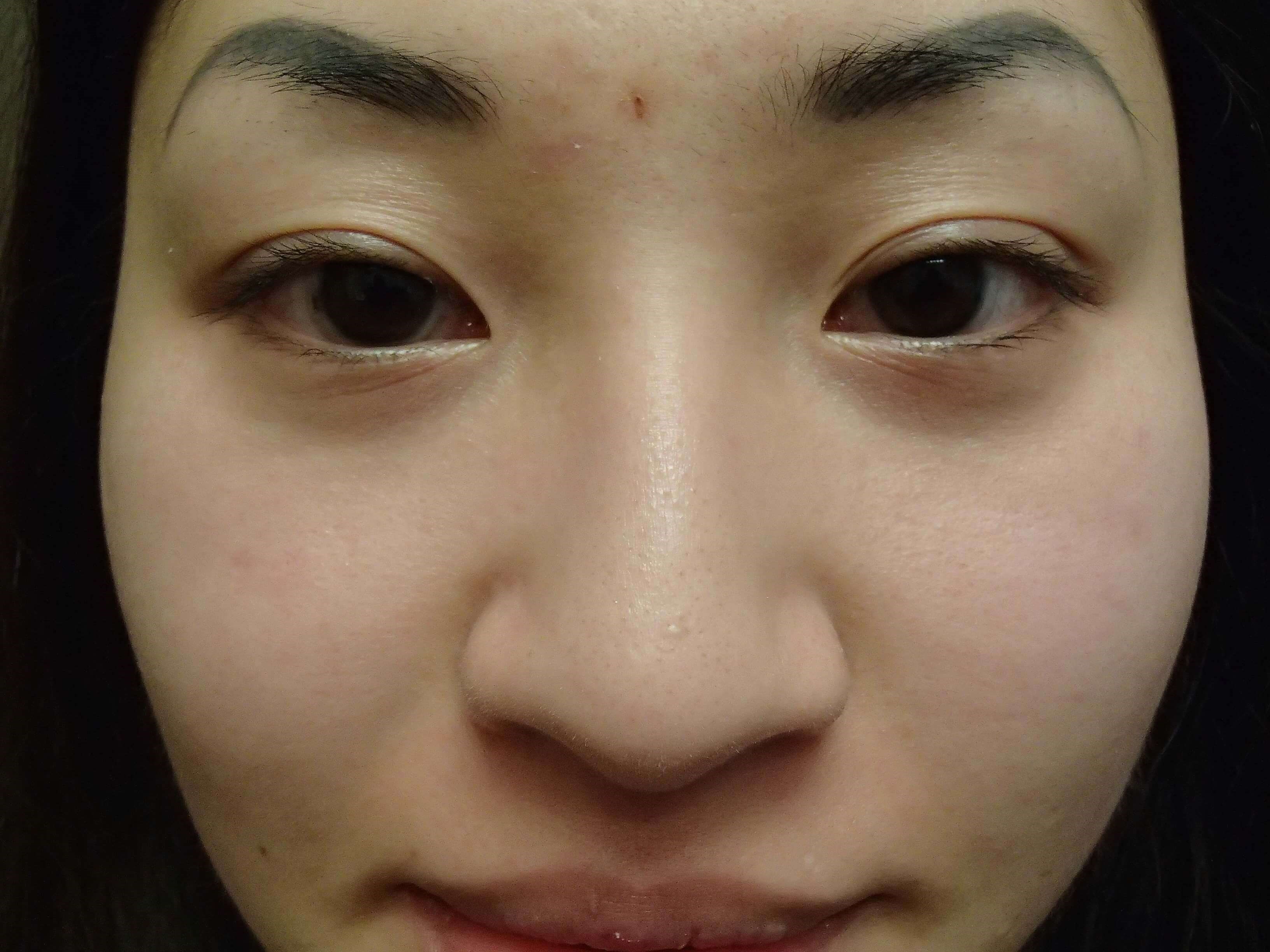 Blepharoplasty Before