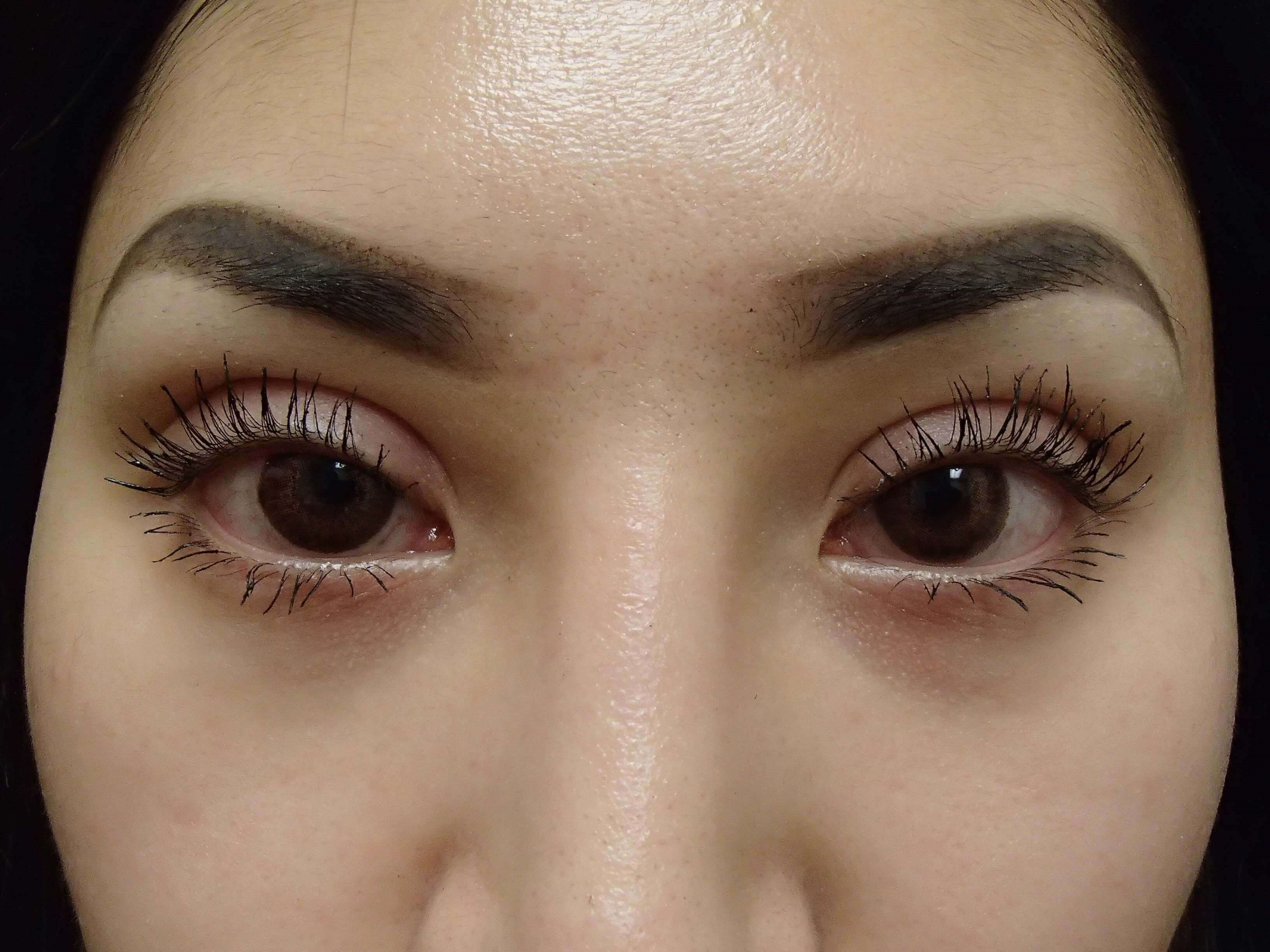 Blepharoplasty After