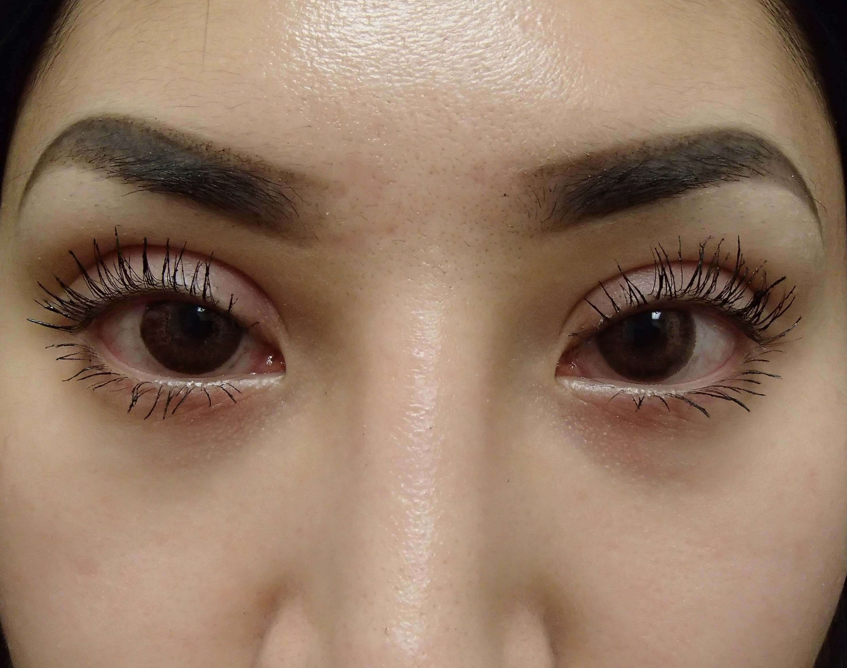 Blepharoplasty After