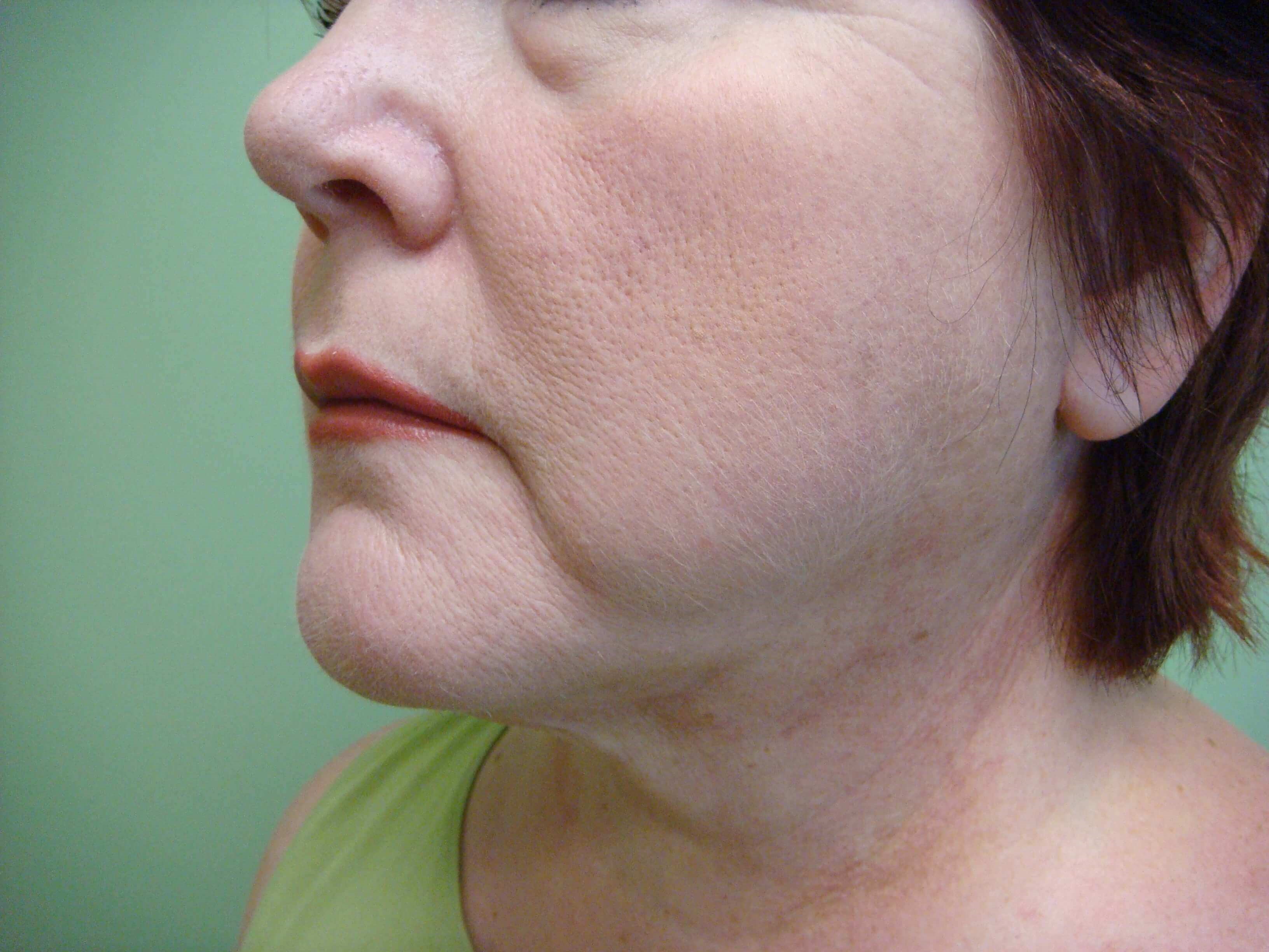 Necklift After