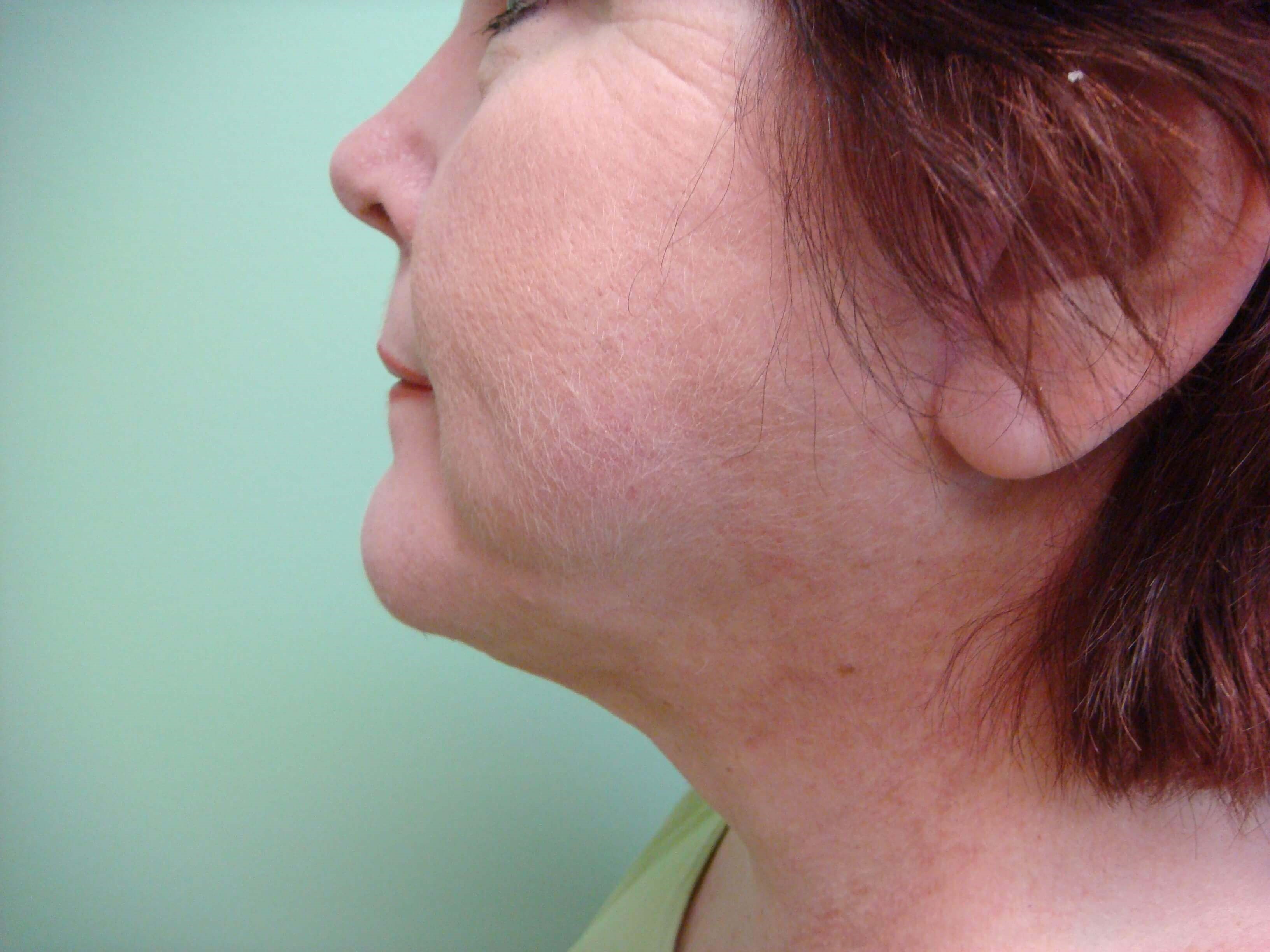 Necklift After