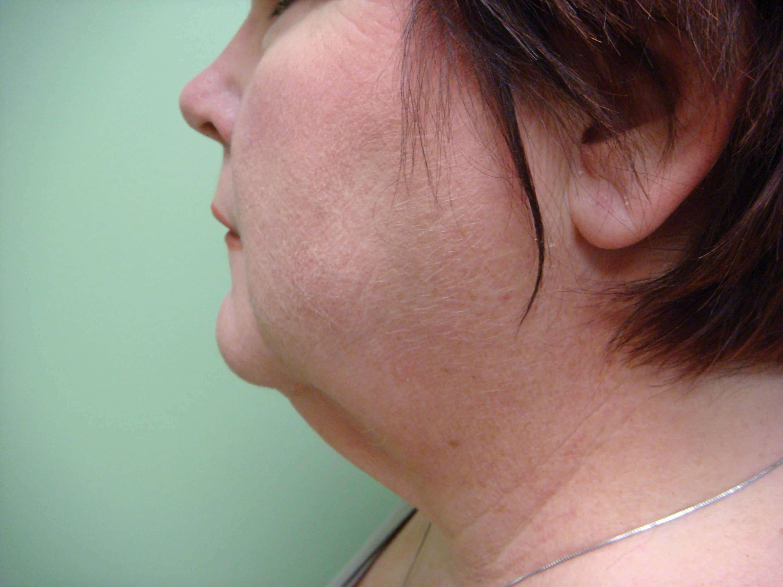 Necklift Before