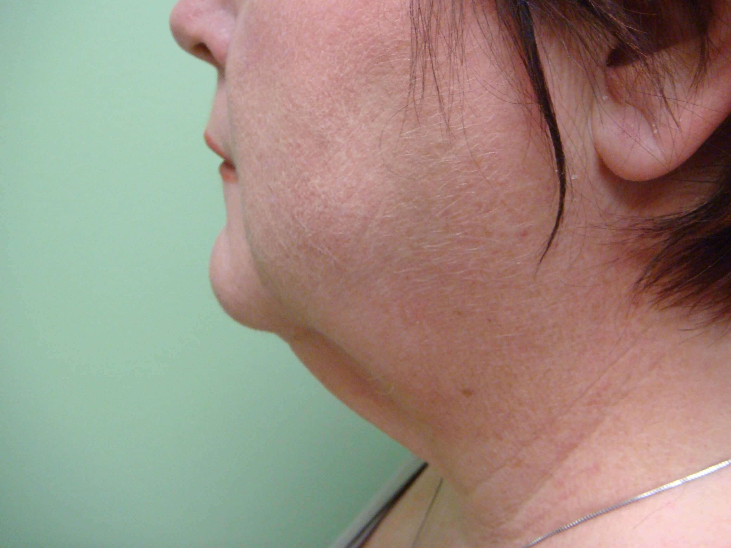 Necklift Before