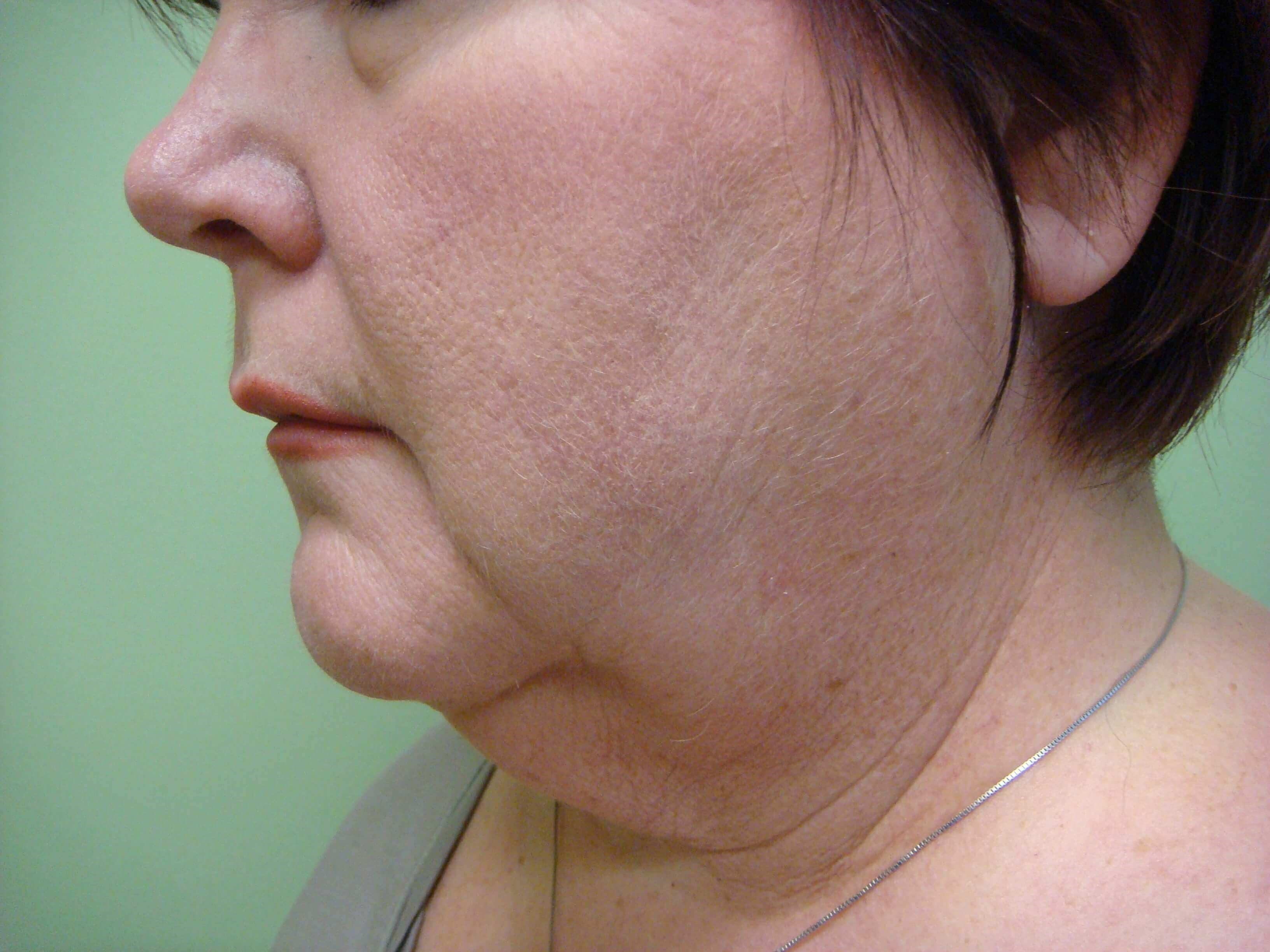 Necklift Before