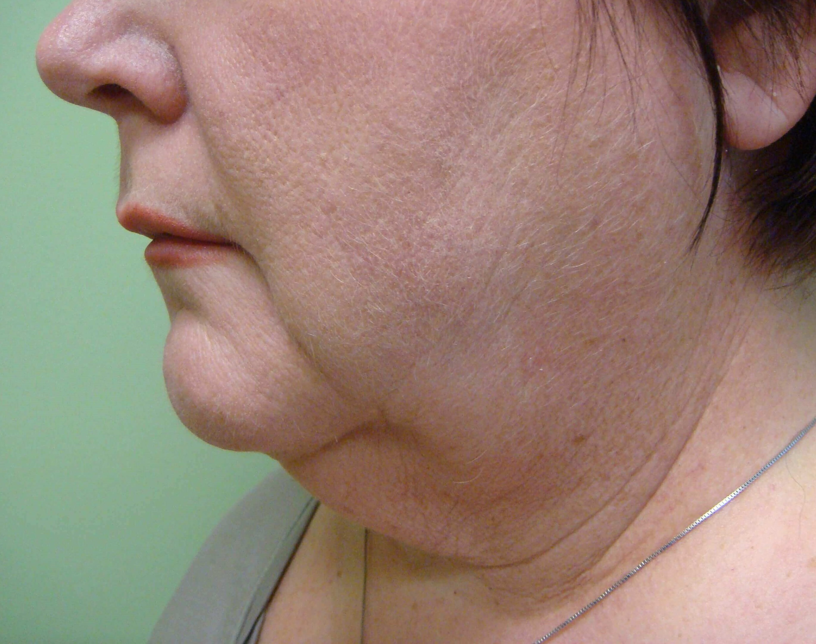 Necklift Before