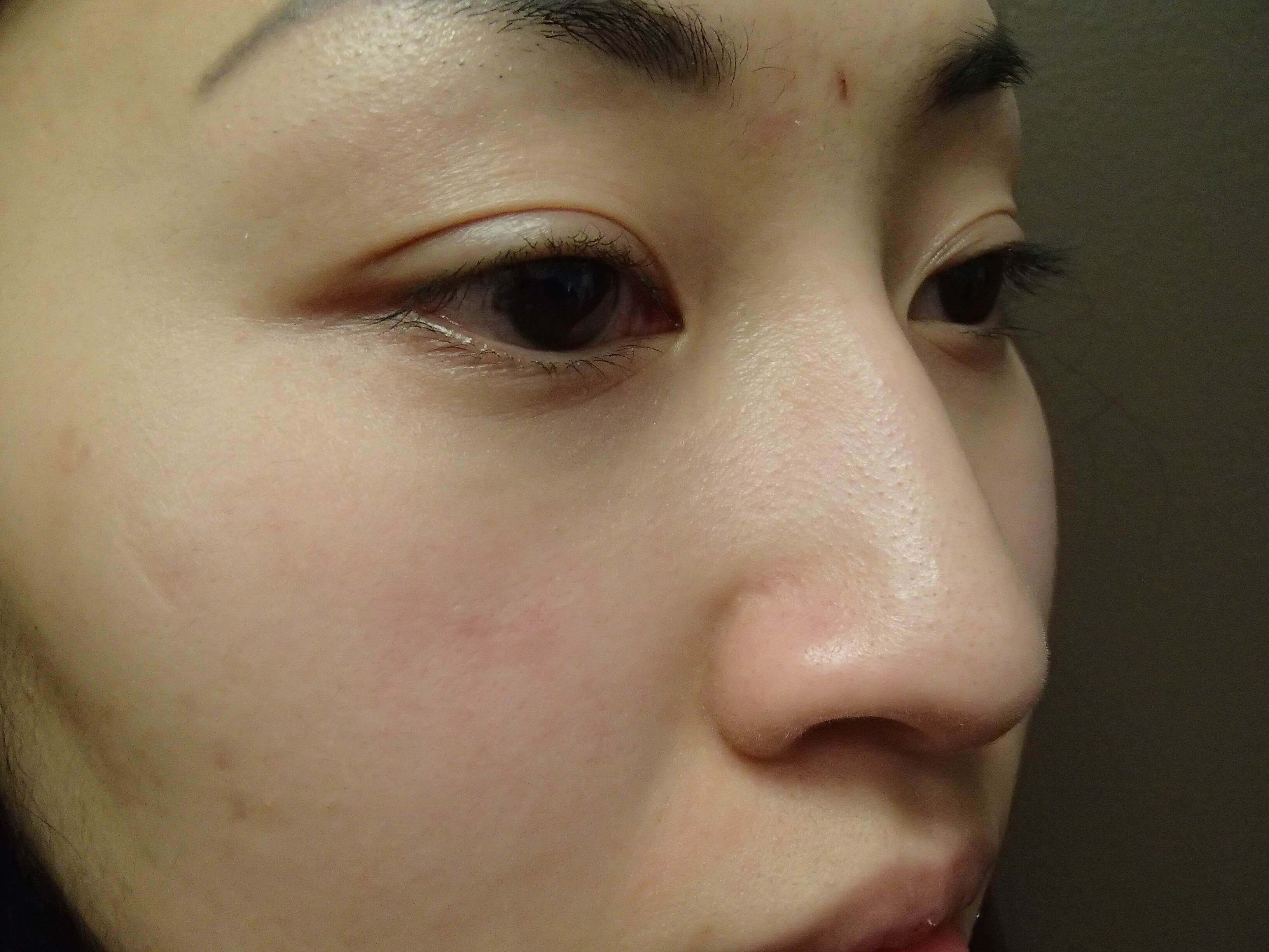 Blepharoplasty Before