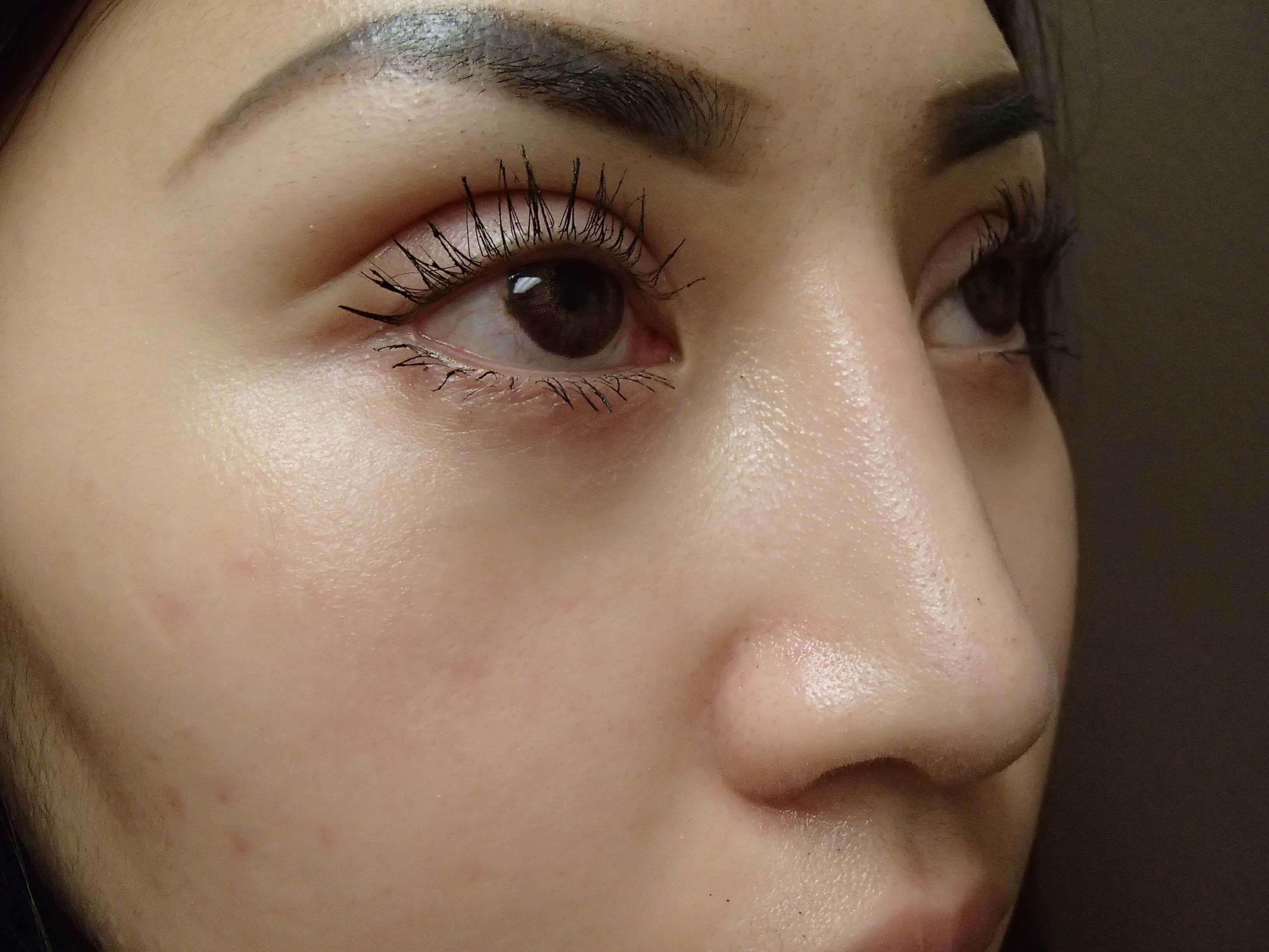 Blepharoplasty After