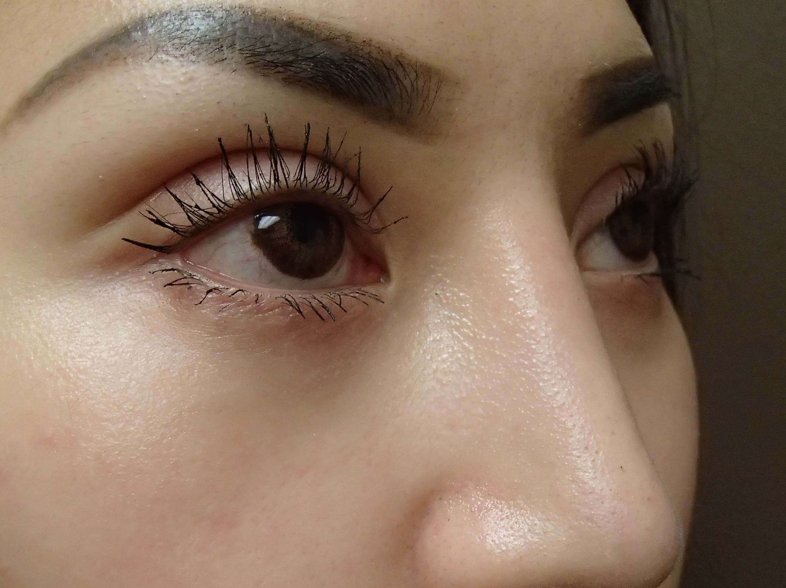 Blepharoplasty After