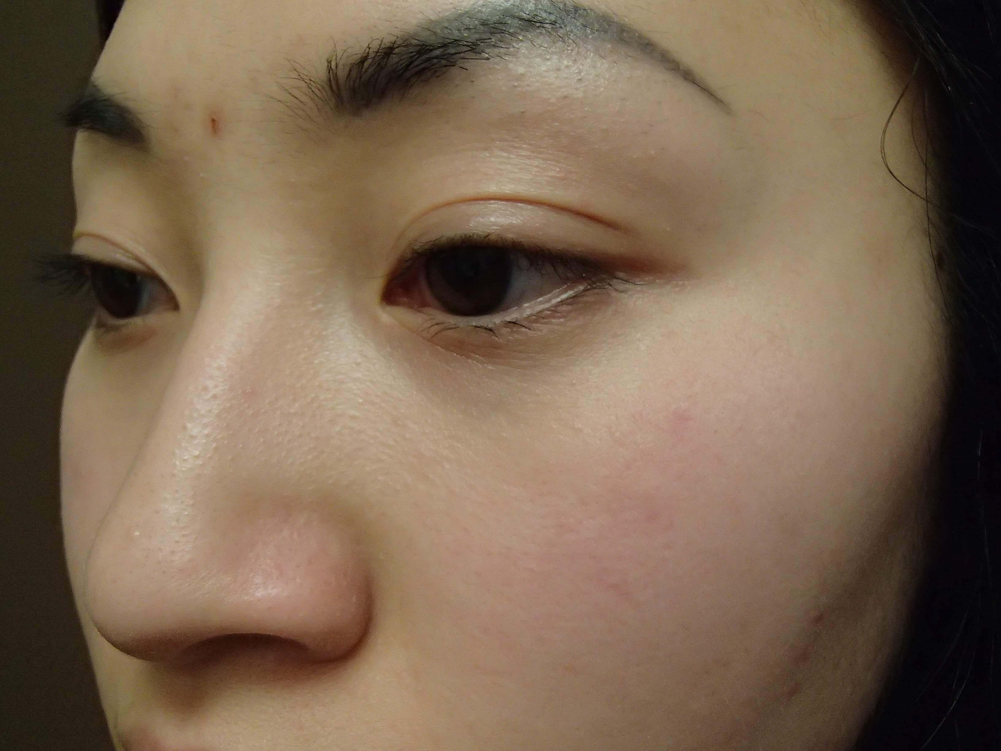 Blepharoplasty Before