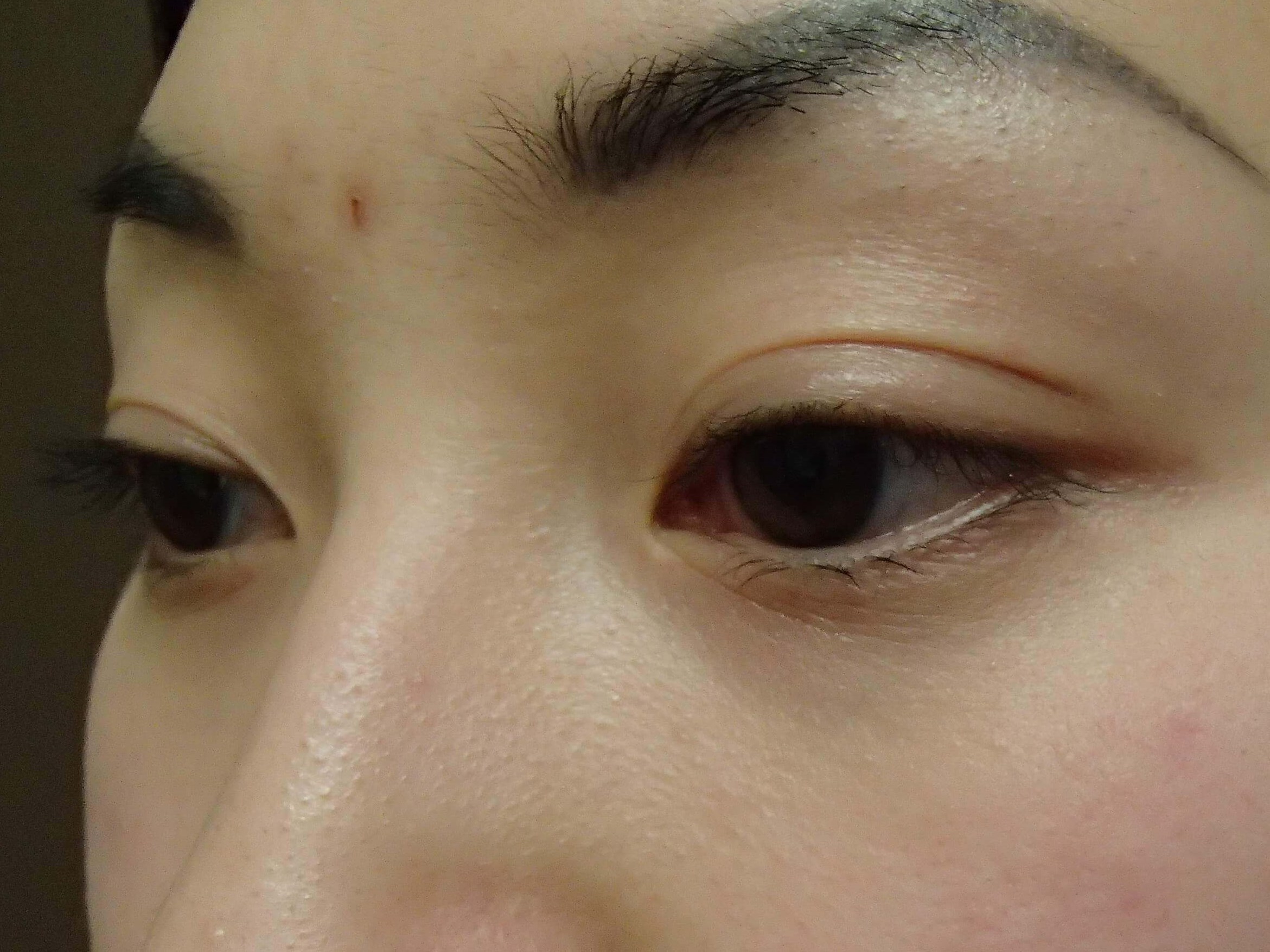 Blepharoplasty Before